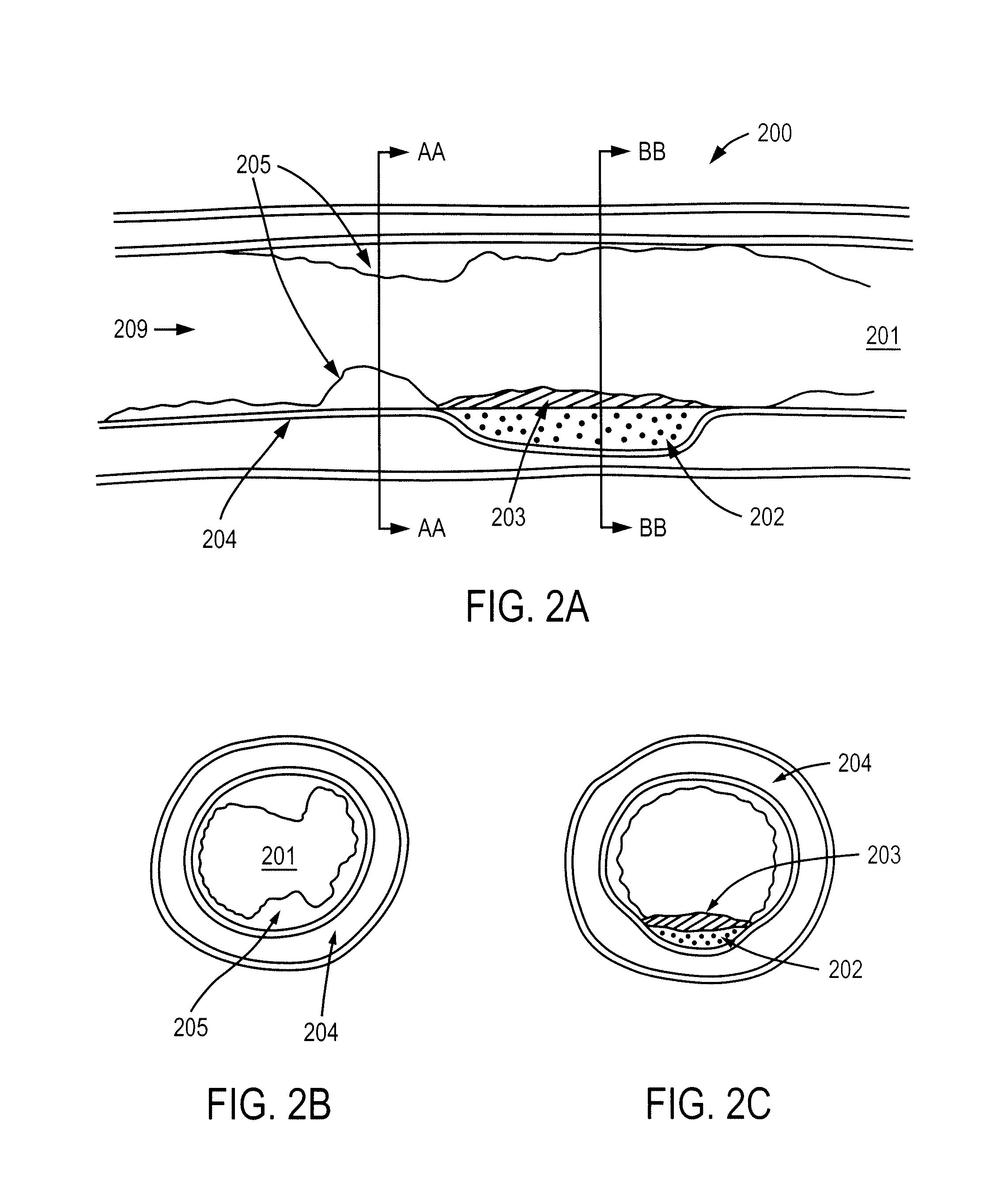 Methods and apparatuses for coating a lesion