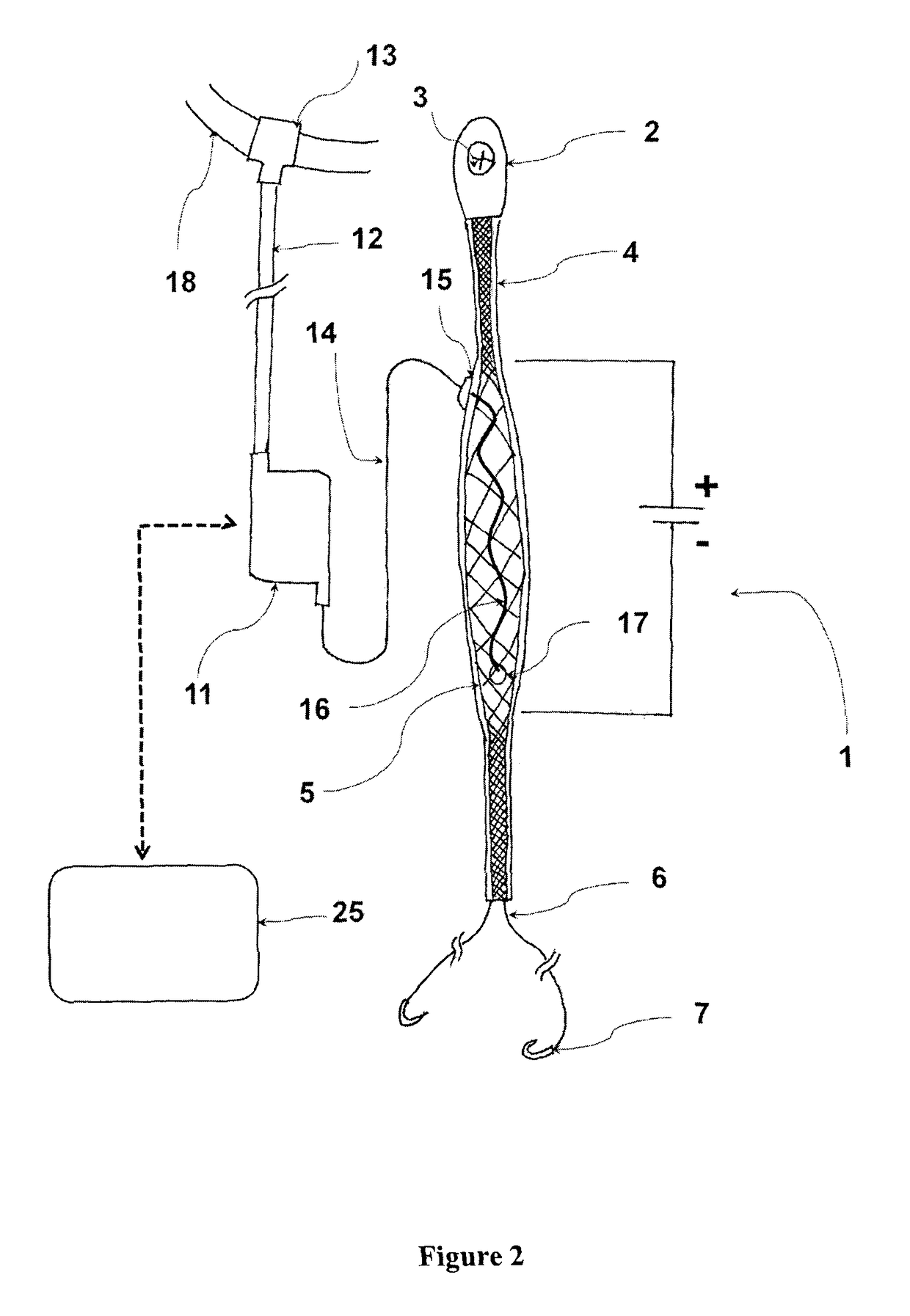 Adjustable elastic antagonist muscle replacement mechanism