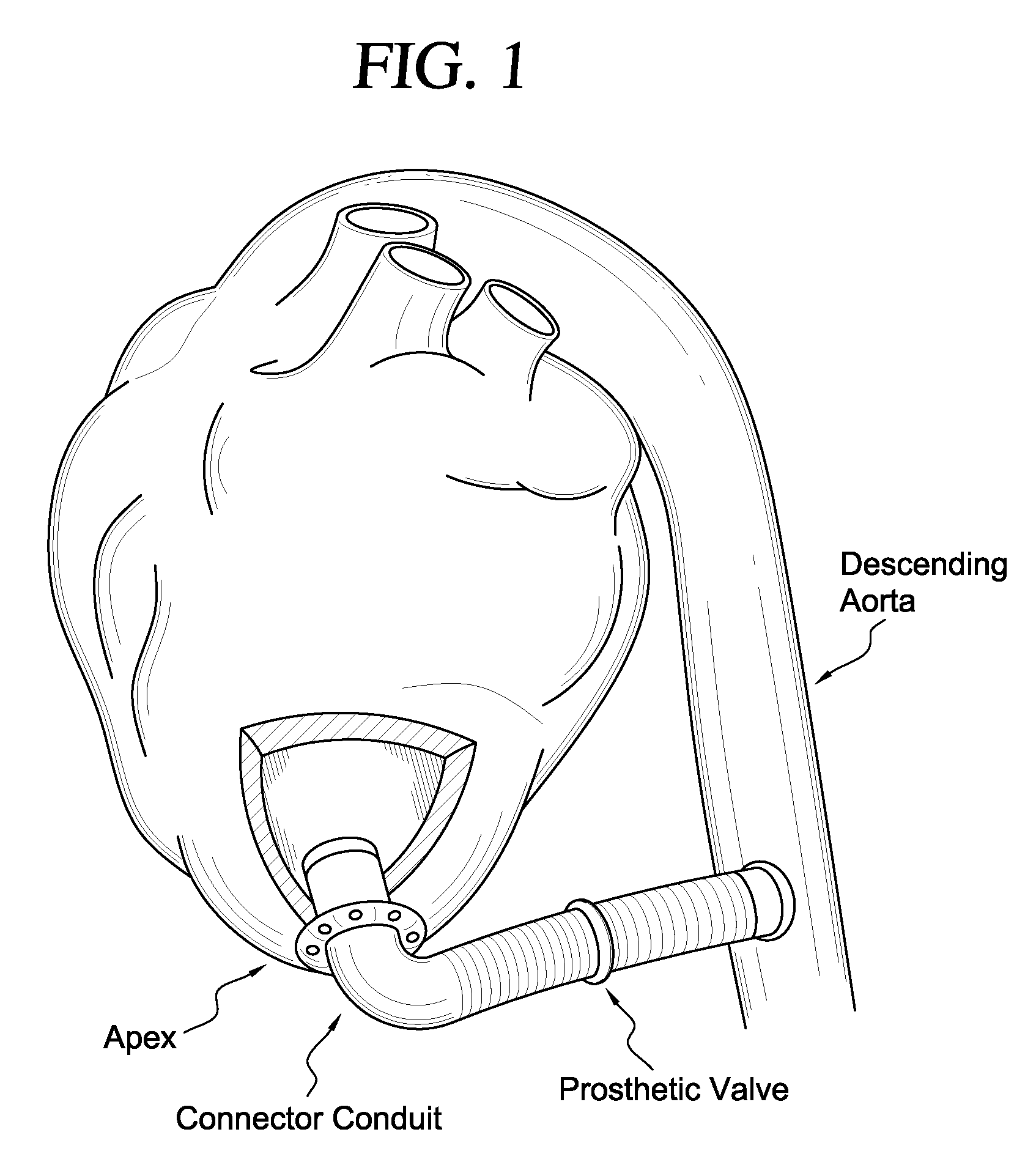 Apparatus and method for suturelessly connecting a conduit to a hollow organ