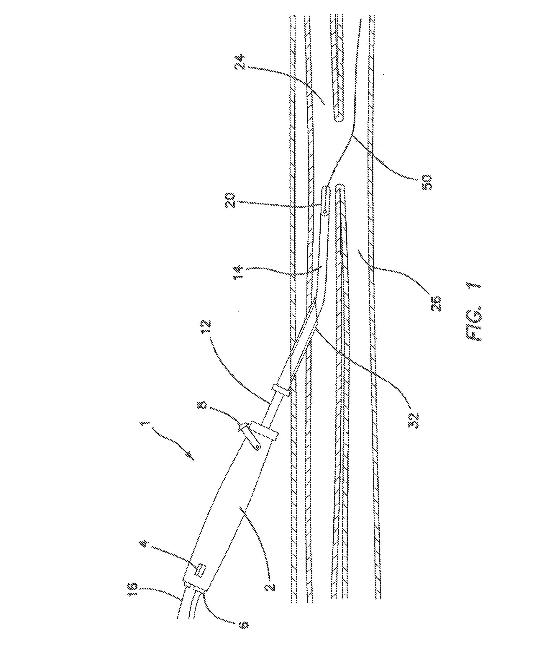 Systems and methods for percutaneous intravascular access for arteriovenous fistula