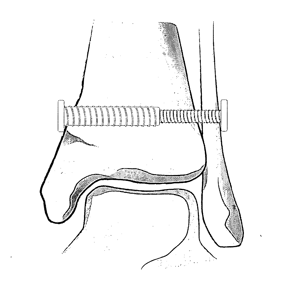 Connecting Cannulated Bone Screws