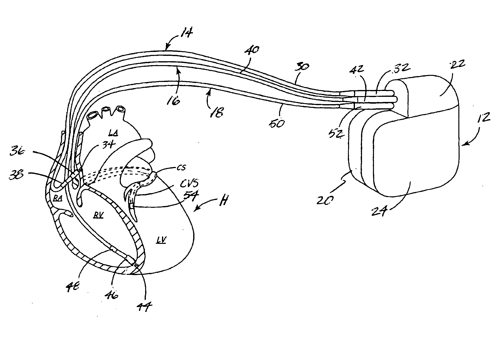 Method and apparatus for detecting left ventricular lead displacement based upon EGM change