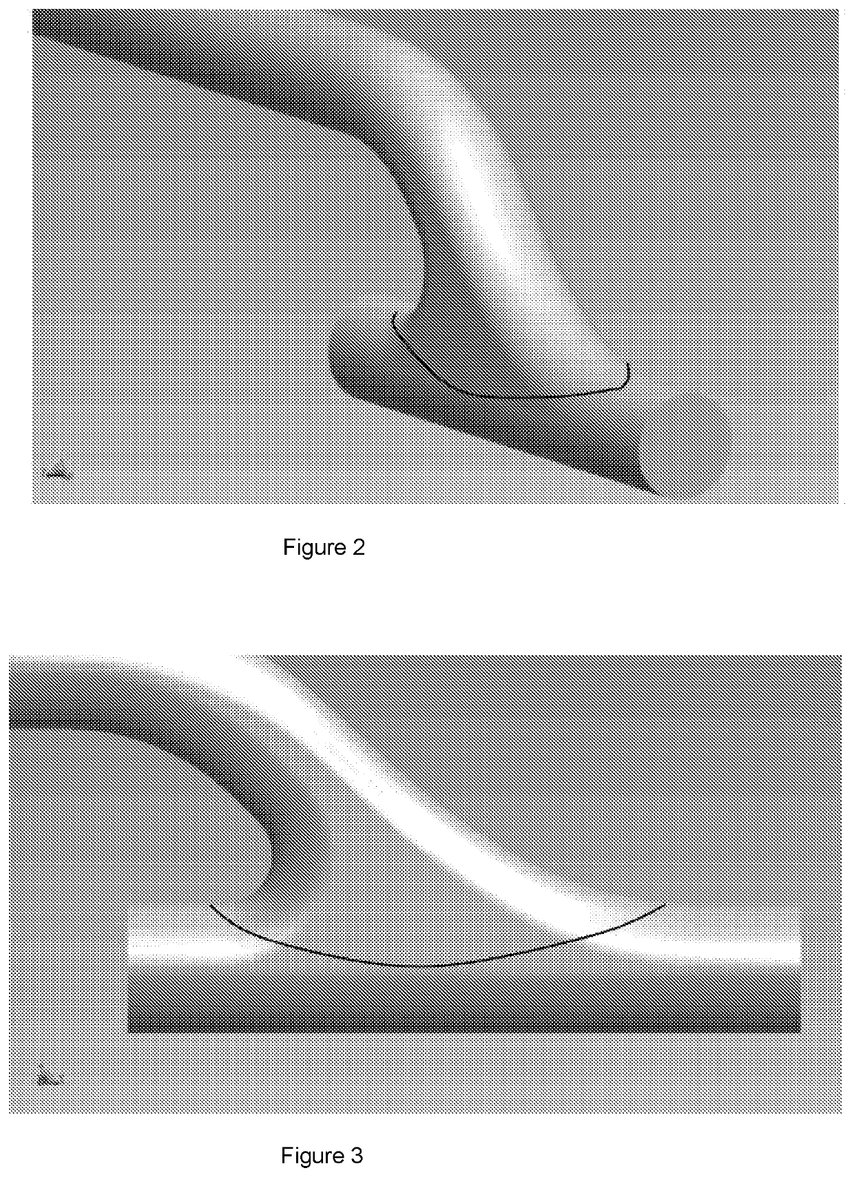 Regenerative tissue and natural tissue implants