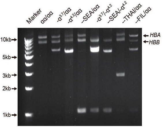 Method and kit for simultaneously detecting multiple mutations of HBA1/2 and HBB gene loci