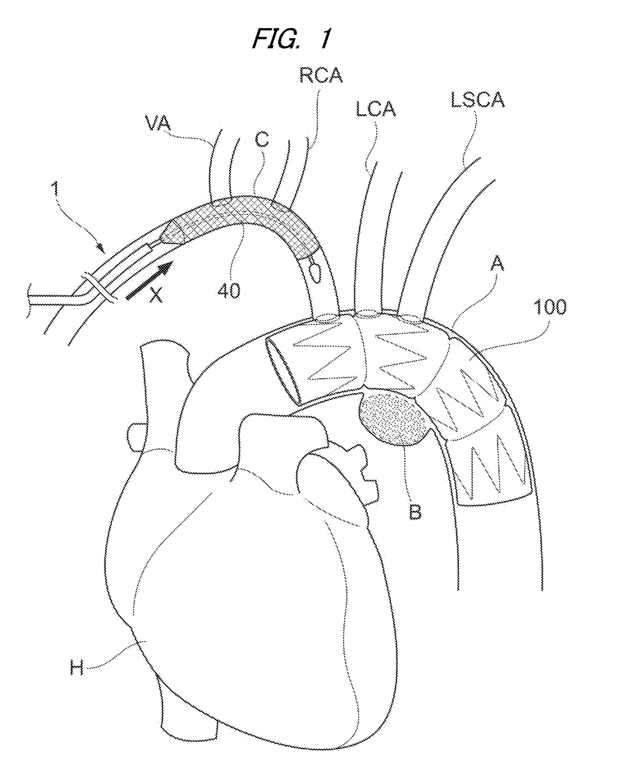 Infarction prevention device and treatment method