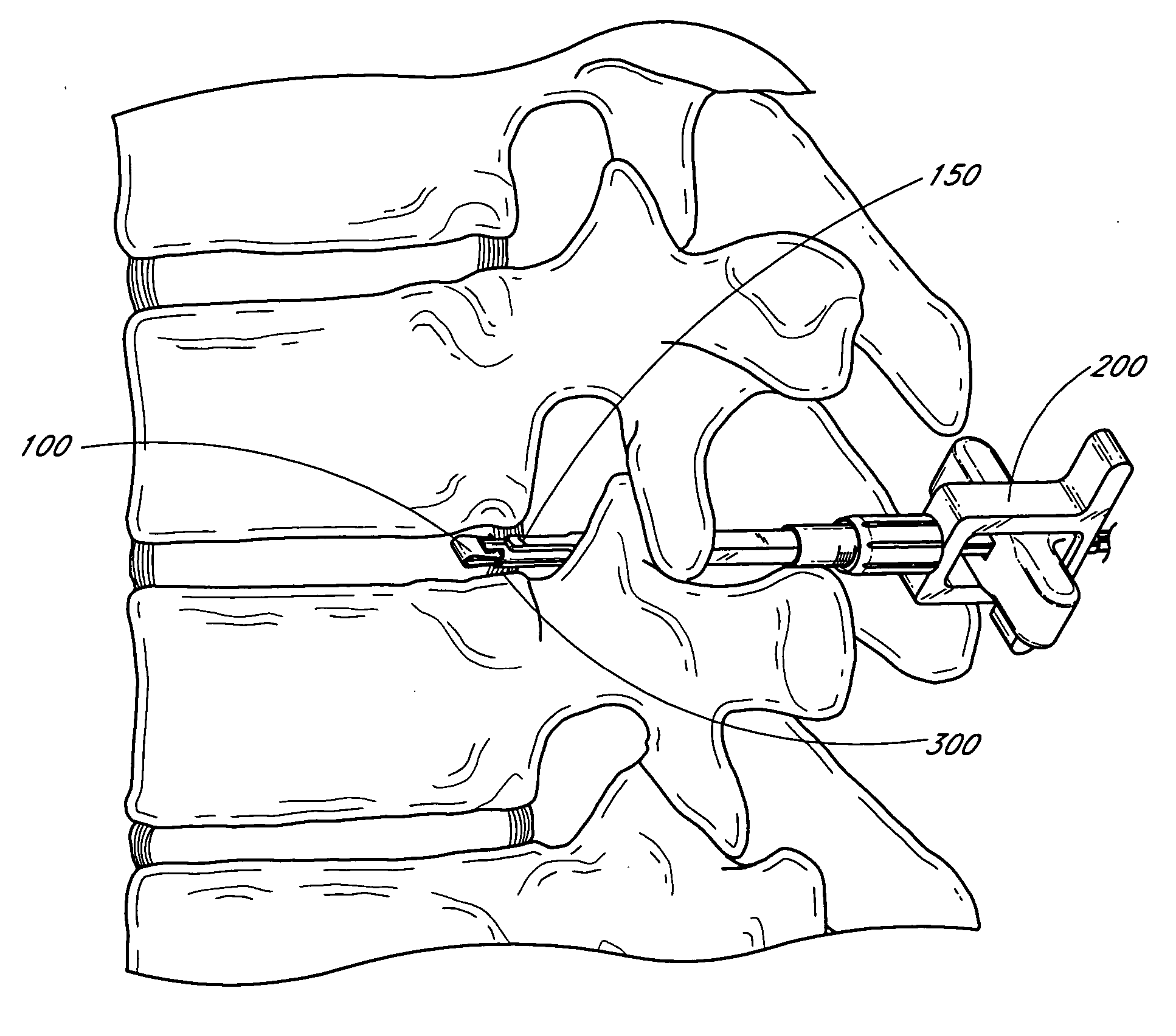 Minimally invasive method for delivery and positioning of intervertebral disc implants