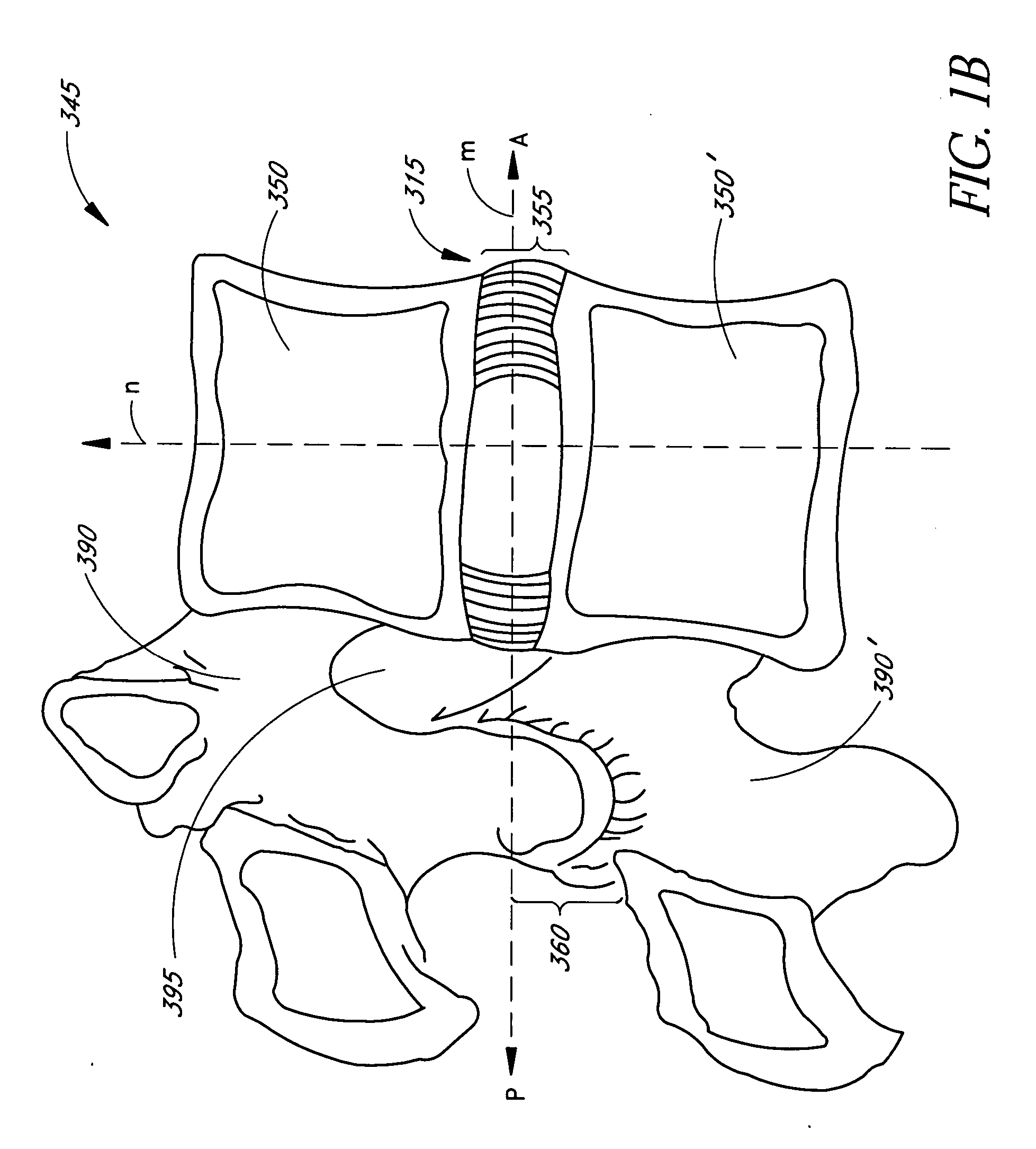 Minimally invasive method for delivery and positioning of intervertebral disc implants
