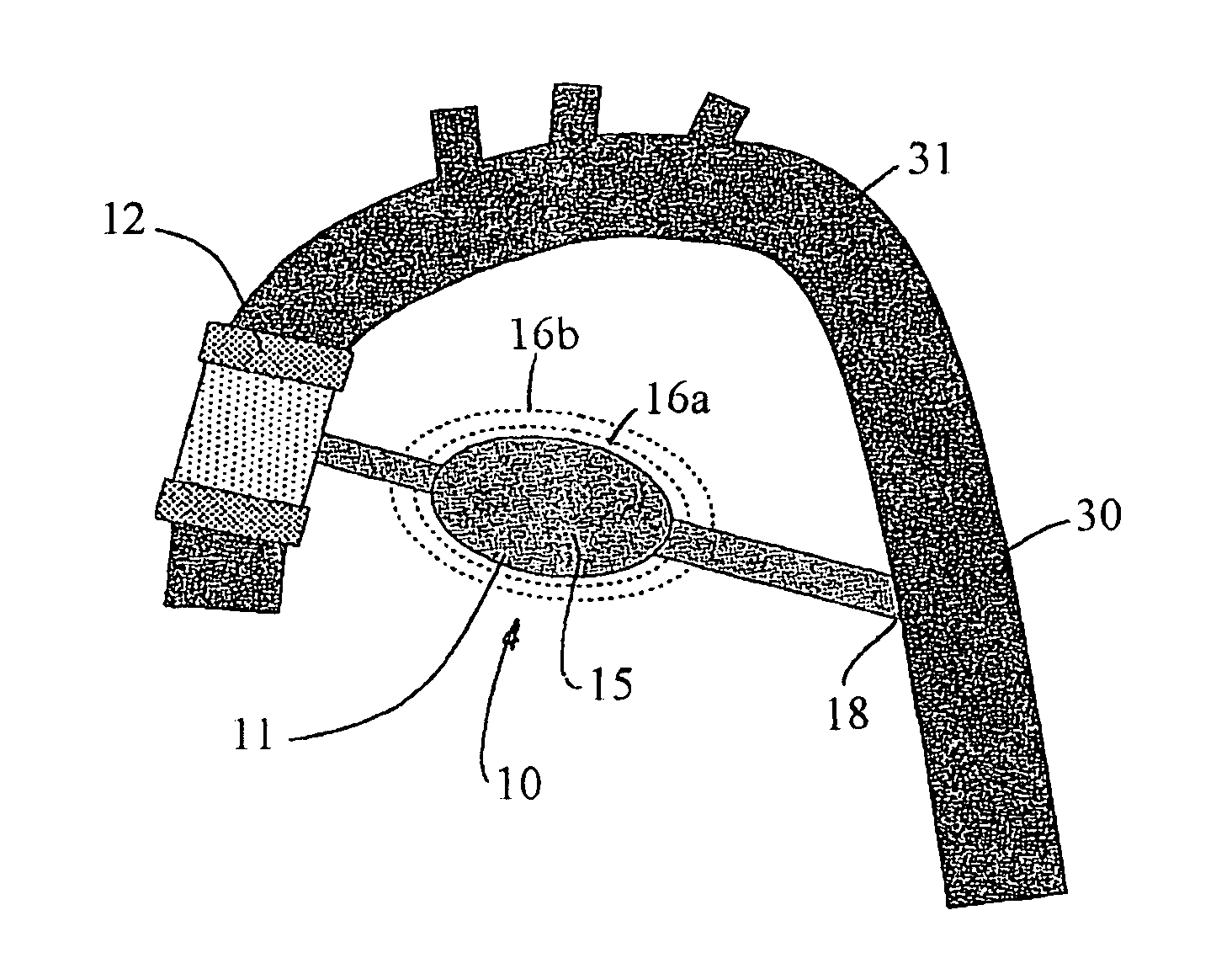 Bypass device for influencing blood pressure