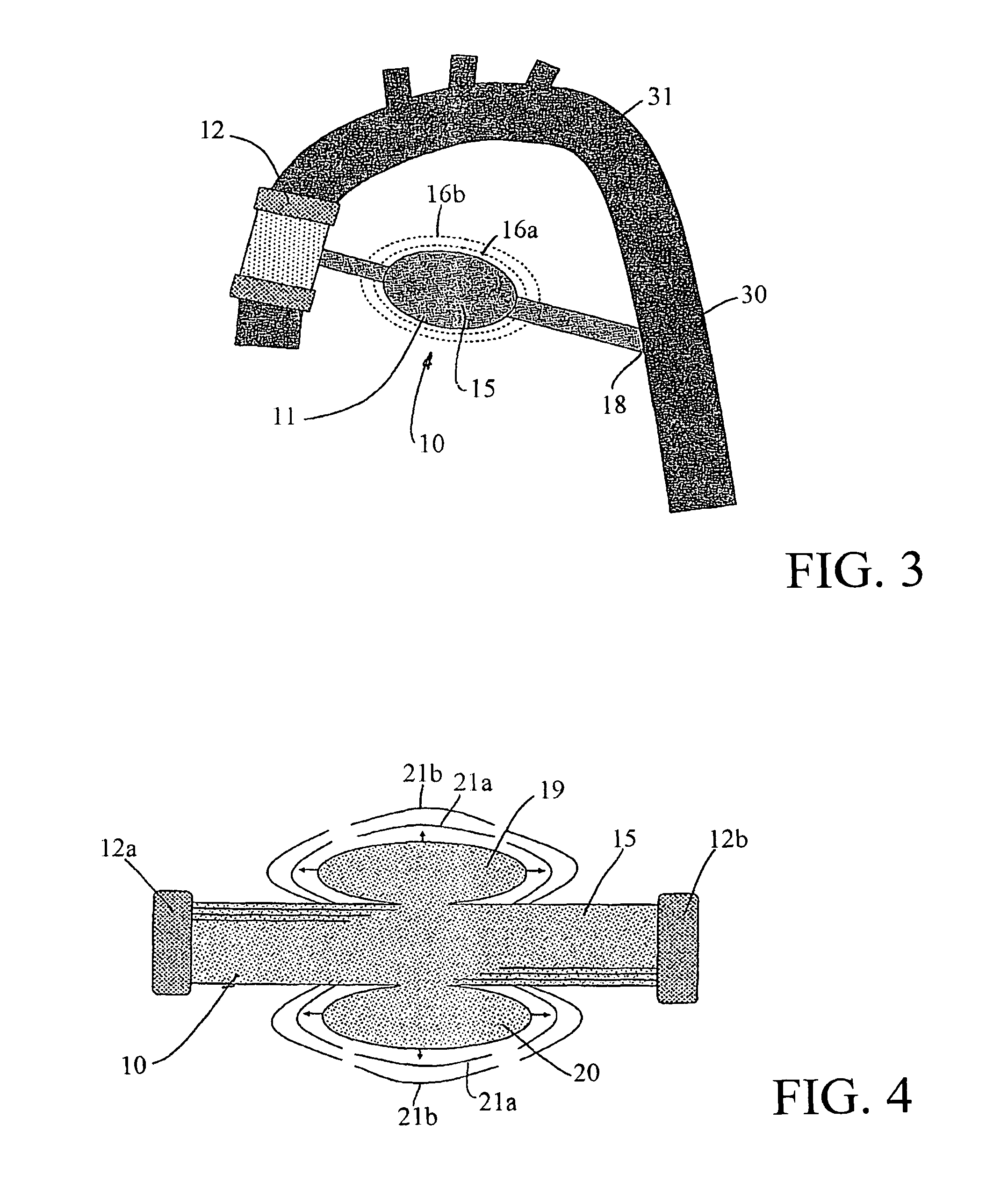 Bypass device for influencing blood pressure