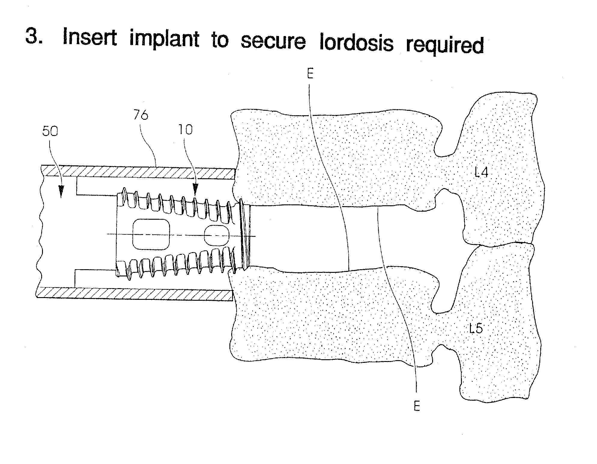 Methods and instruments for interbody fusion