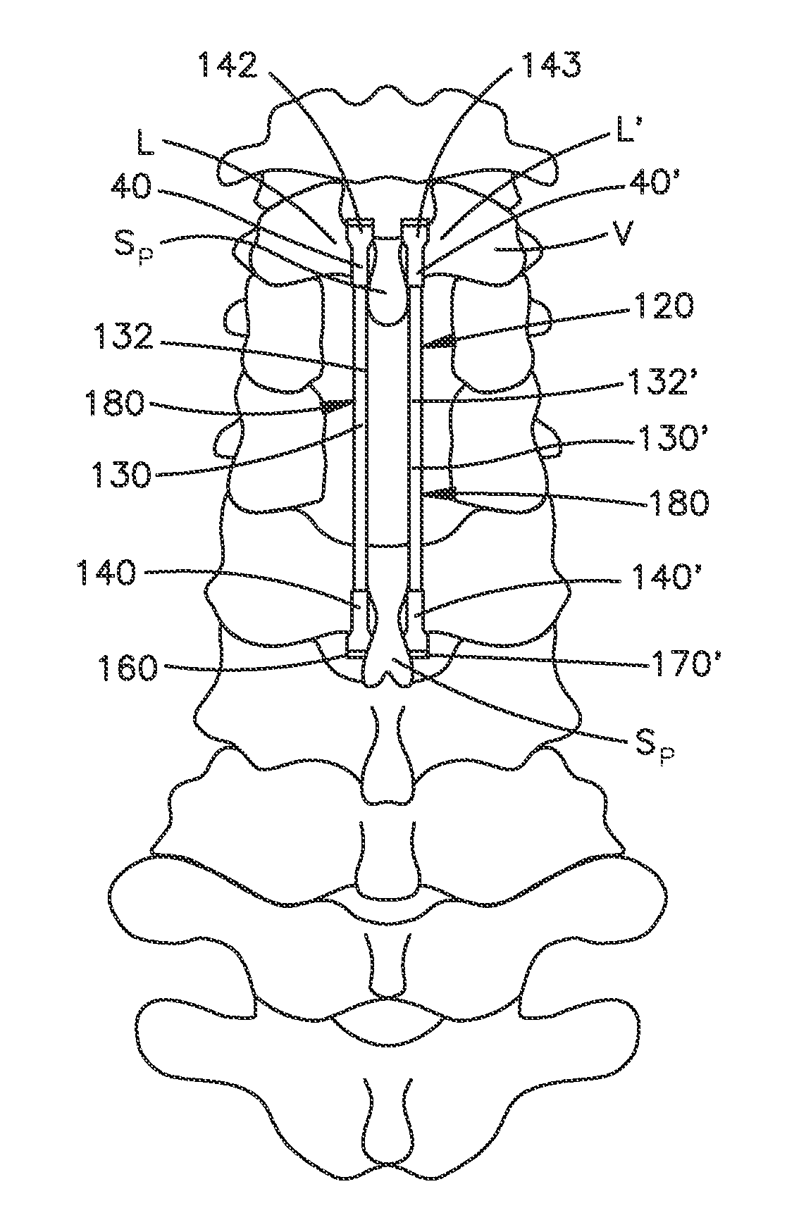 Spine stabilization system and method