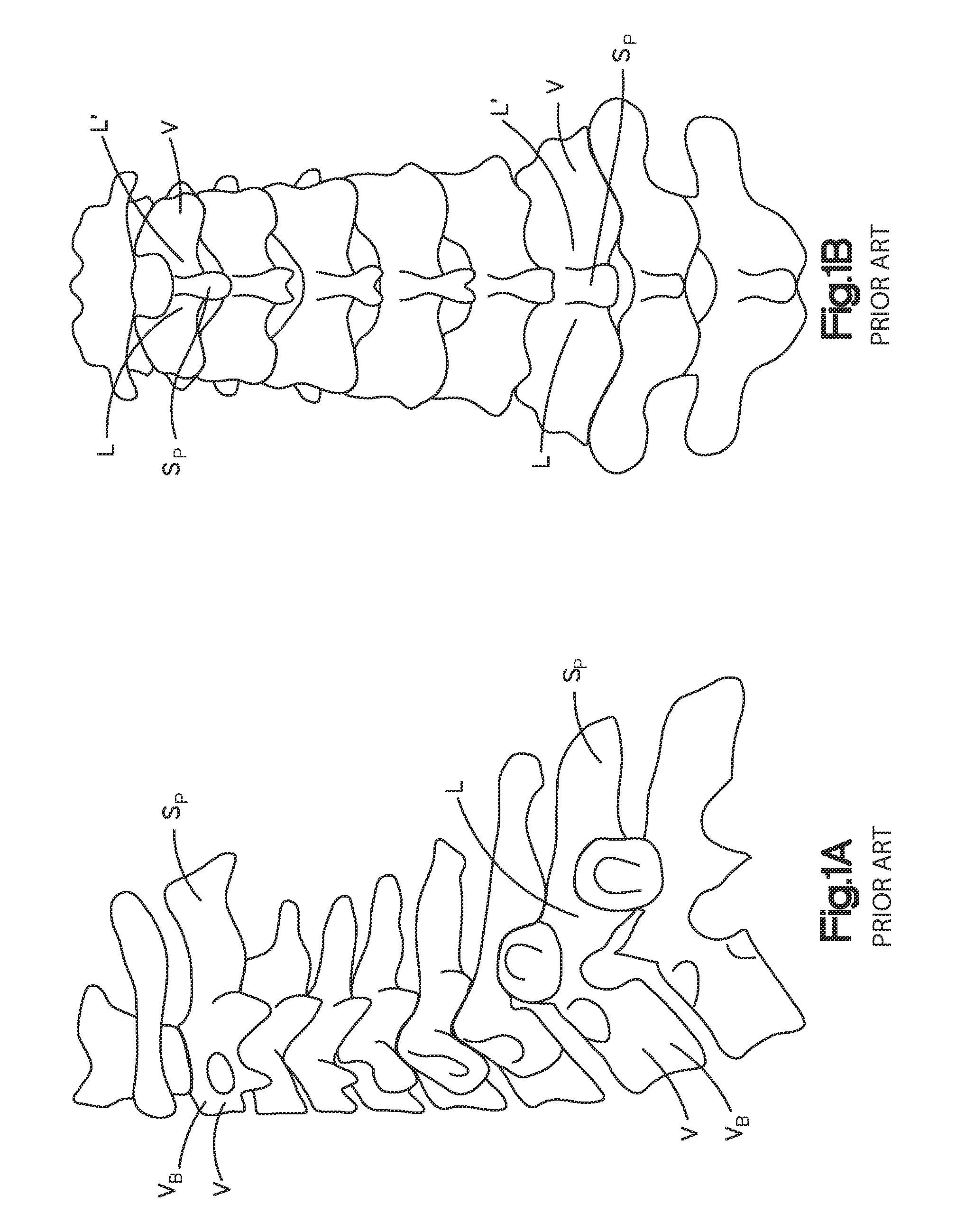 Spine stabilization system and method