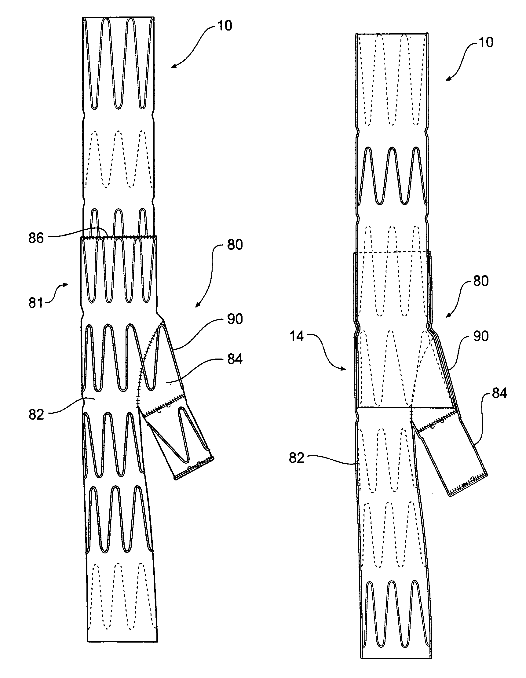 Iliac extension with flared cuff