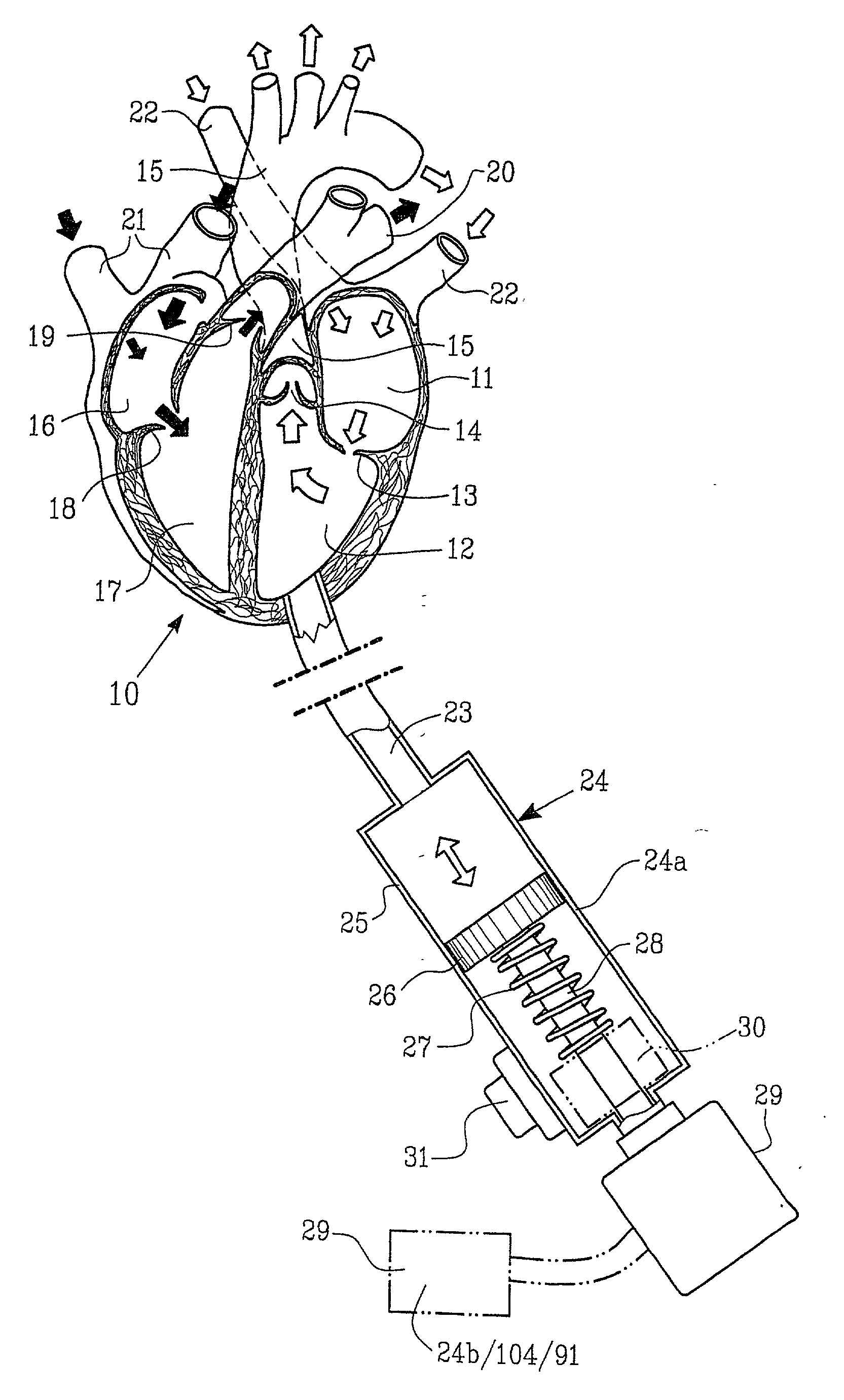 Implantable device for utilisation of the hydraulic energy of the heart