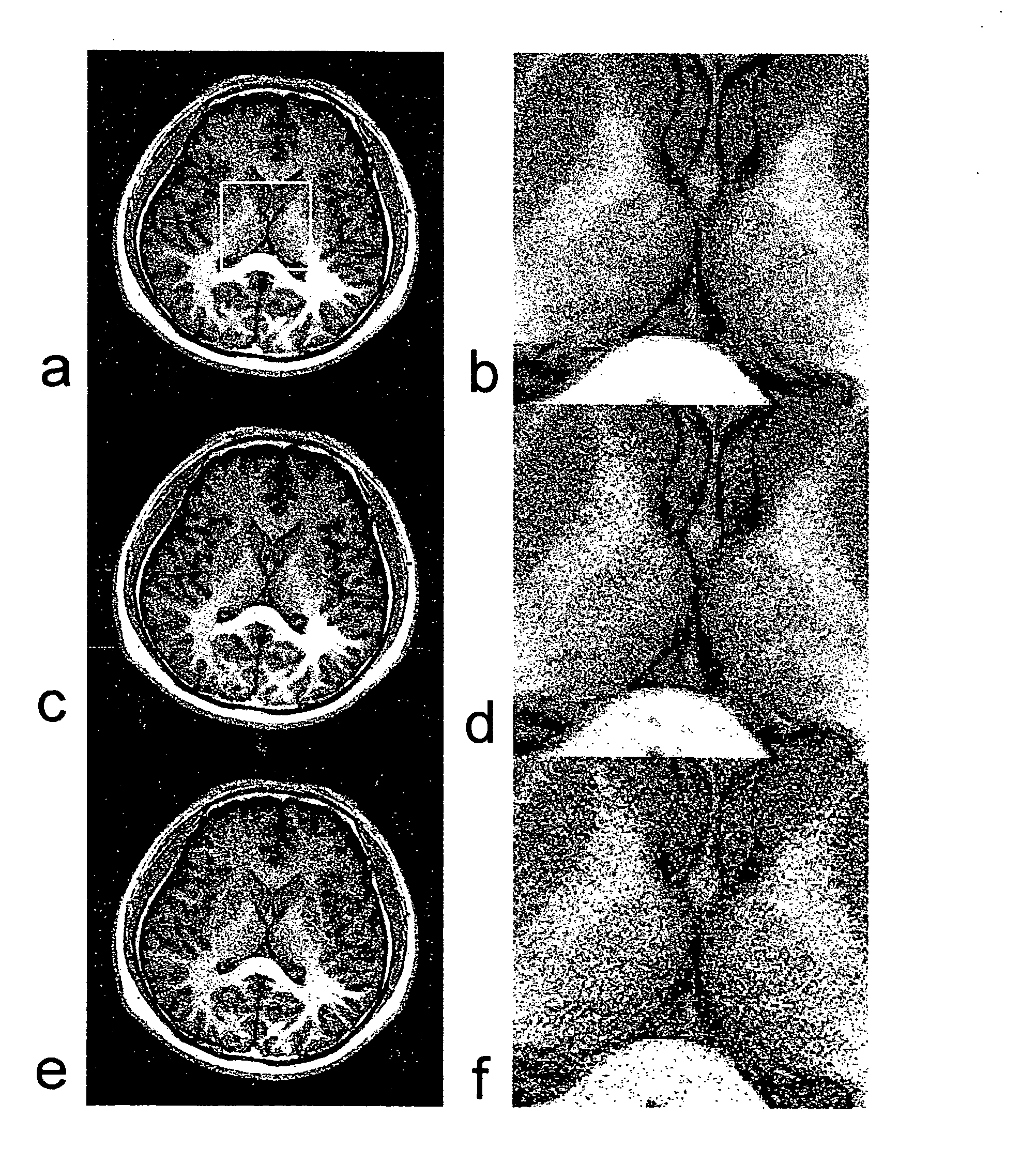 Method and Apparatus for Parameter Free Regularized Partially Parallel Imaging Using Magnetic Resonance Imaging