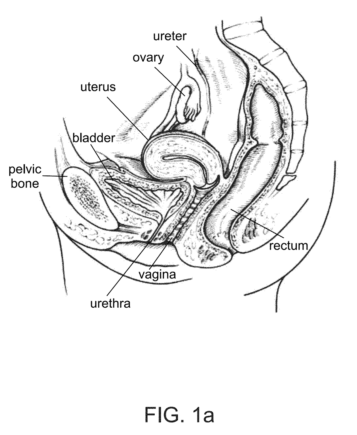 Device positionable in the uterine cavity