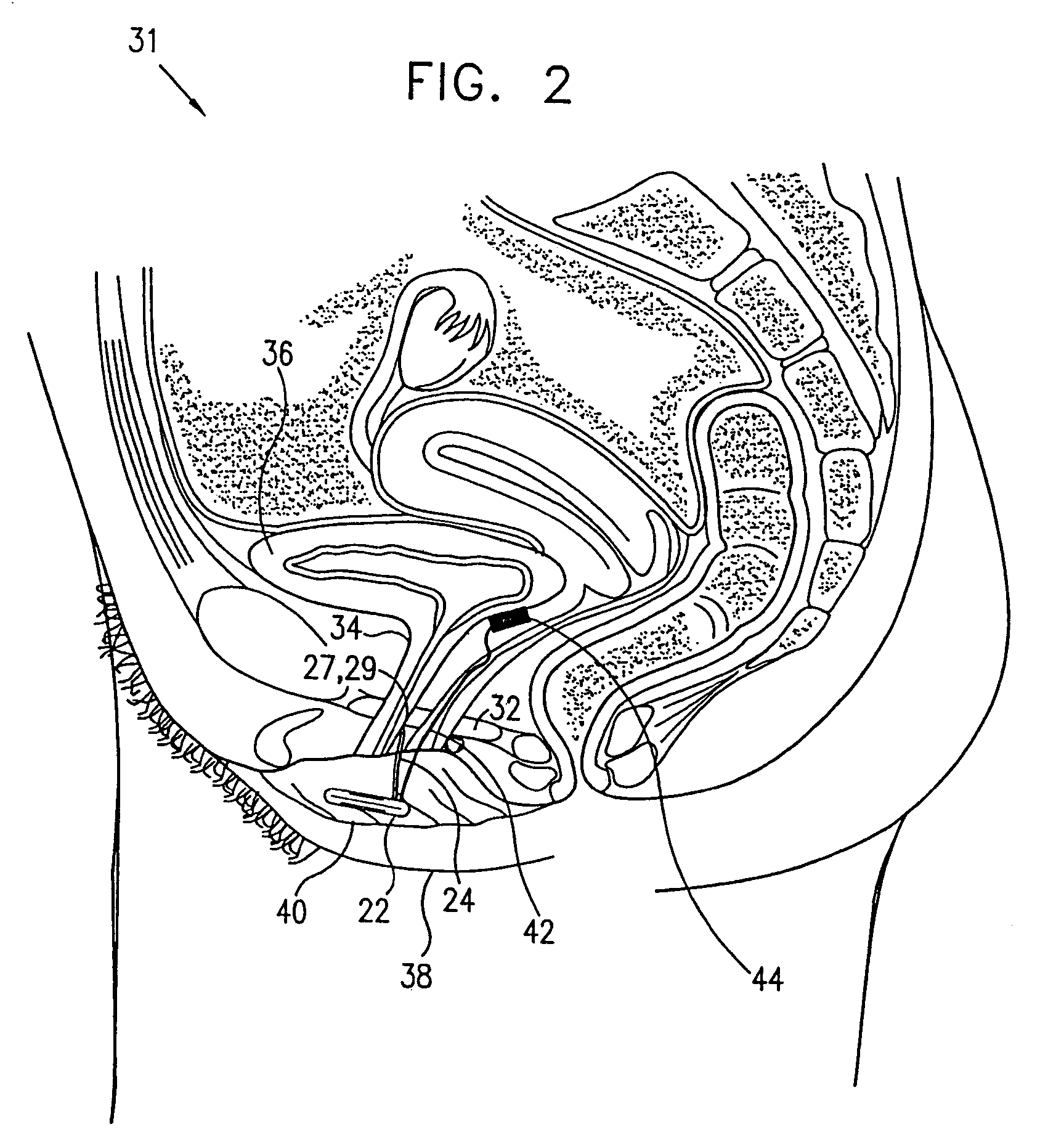 Incontinence treatment device