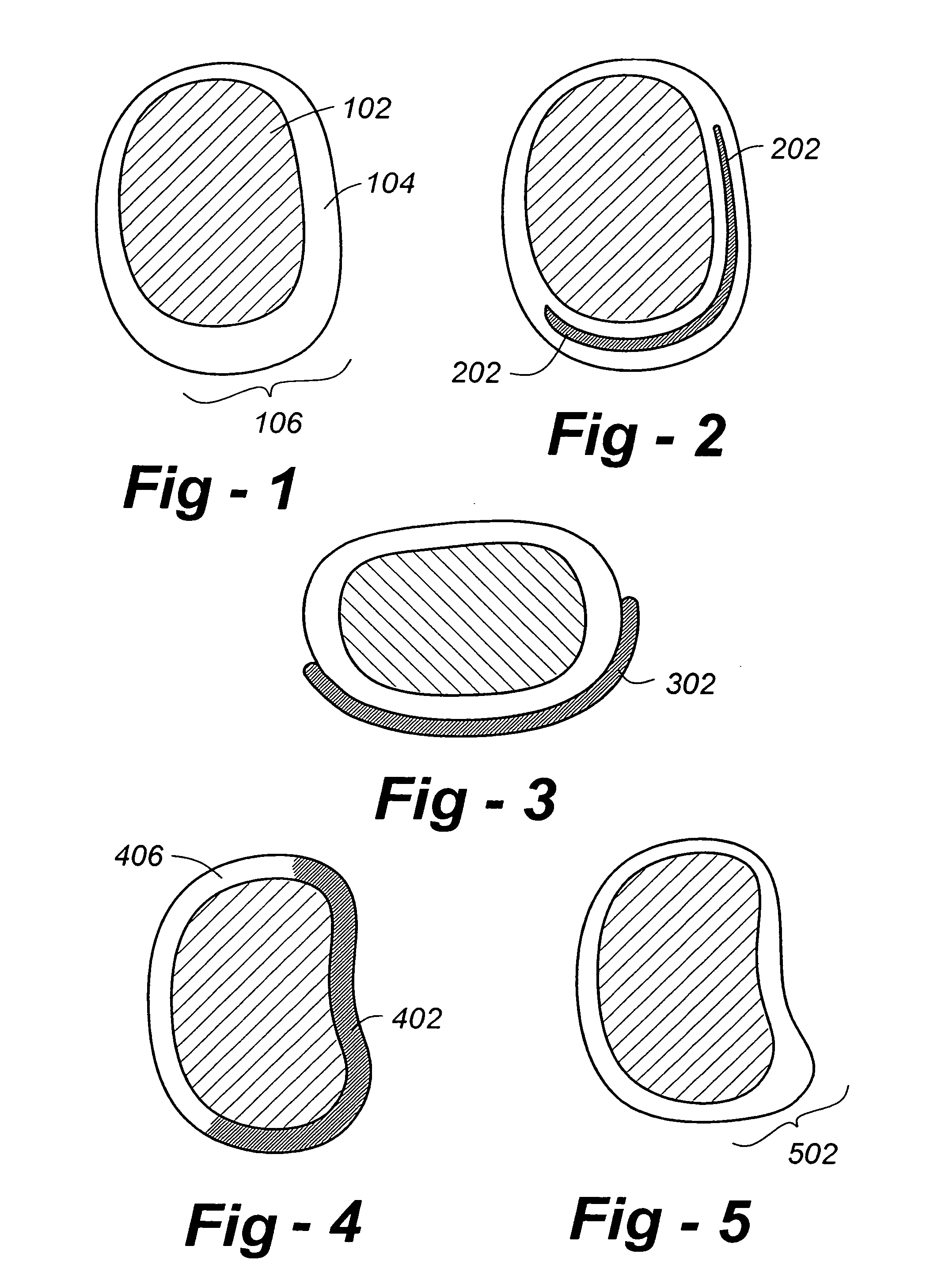 Artificial intervertebral disc replacements incorporating reinforced wall sections
