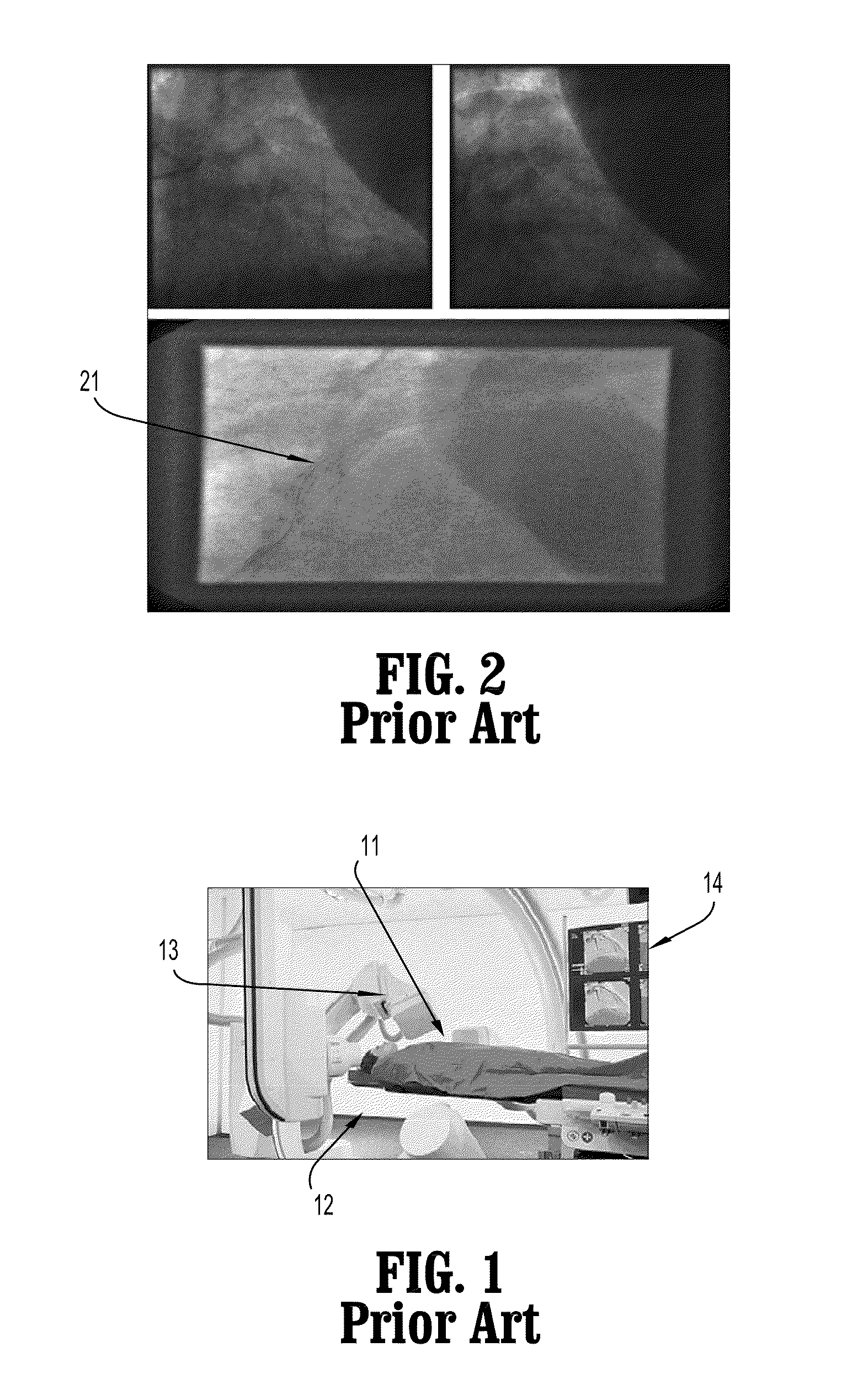 System and method for simultaneously subsampling fluoroscopic images and enhancing guidewire visibility