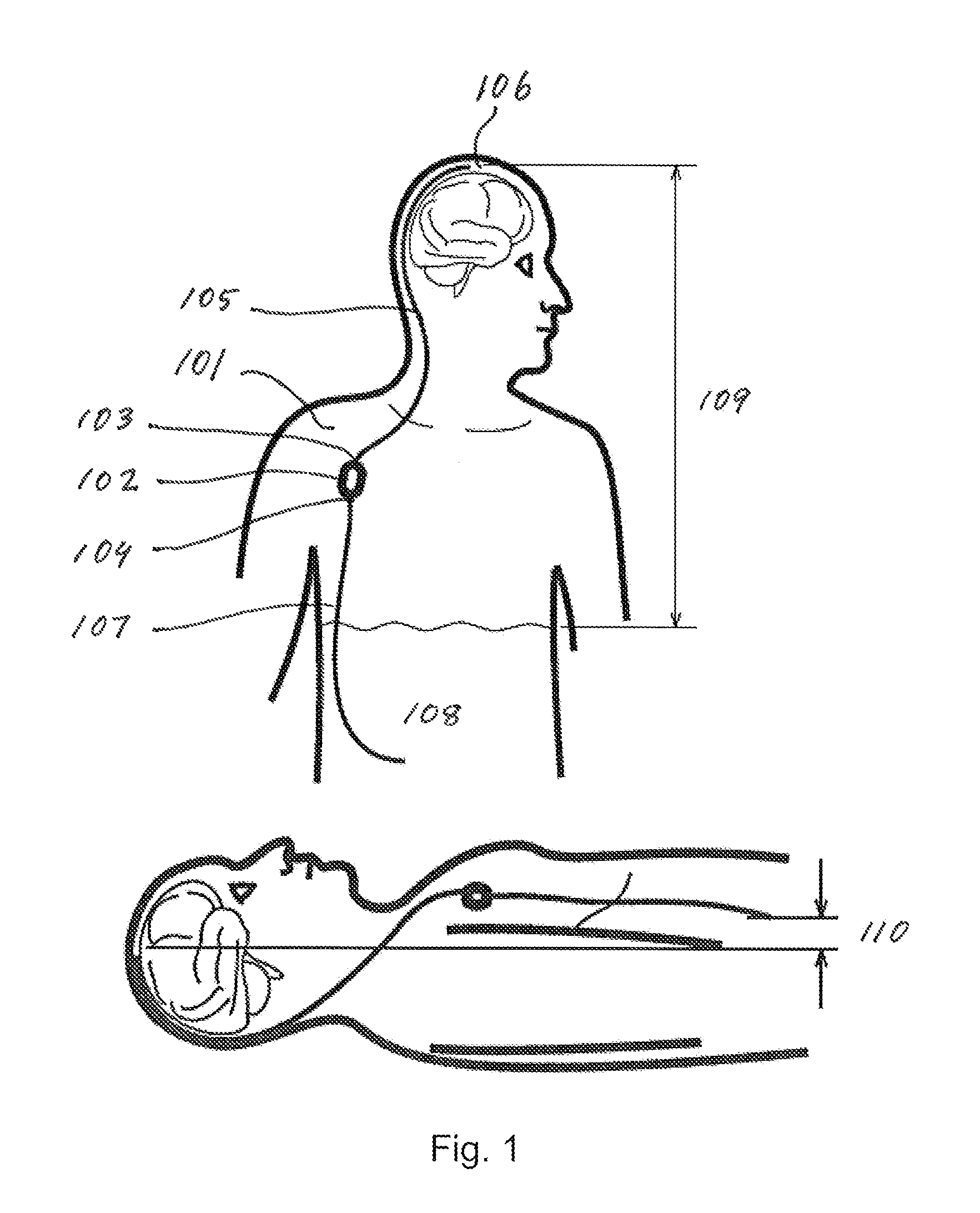 Cerebrospinal fluid shunt for treatment of hydrocephalus