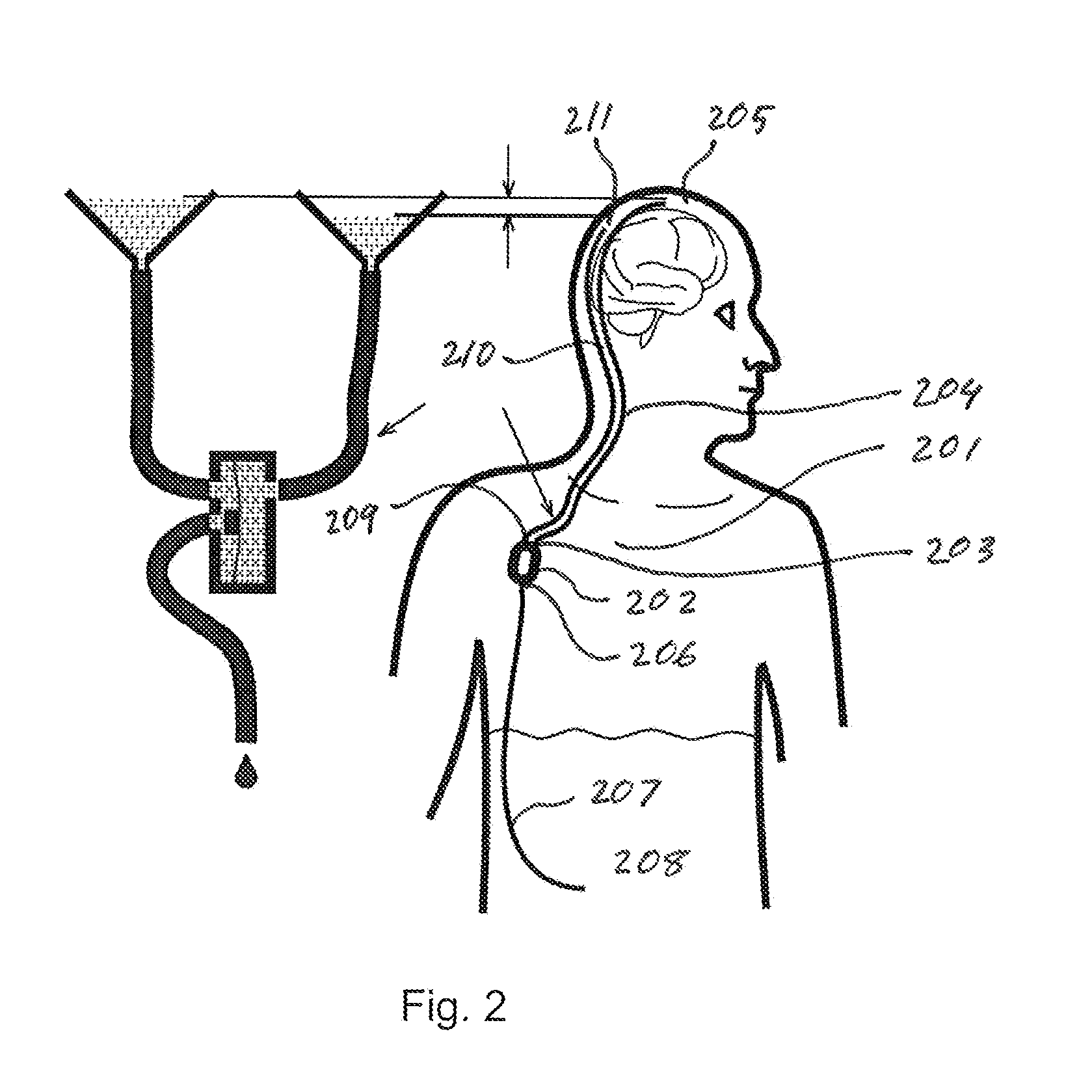 Cerebrospinal fluid shunt for treatment of hydrocephalus