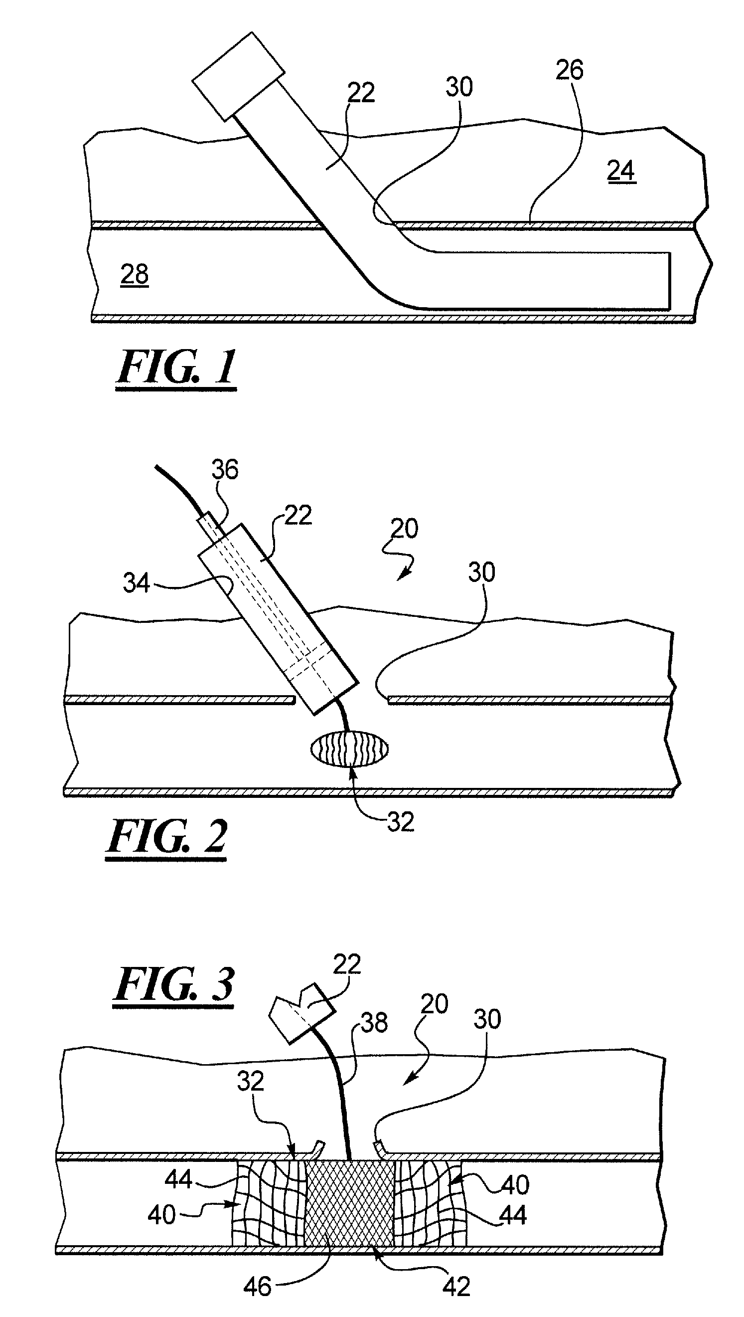 Apparatus and Method for Sealing a Vessel Puncture Opening