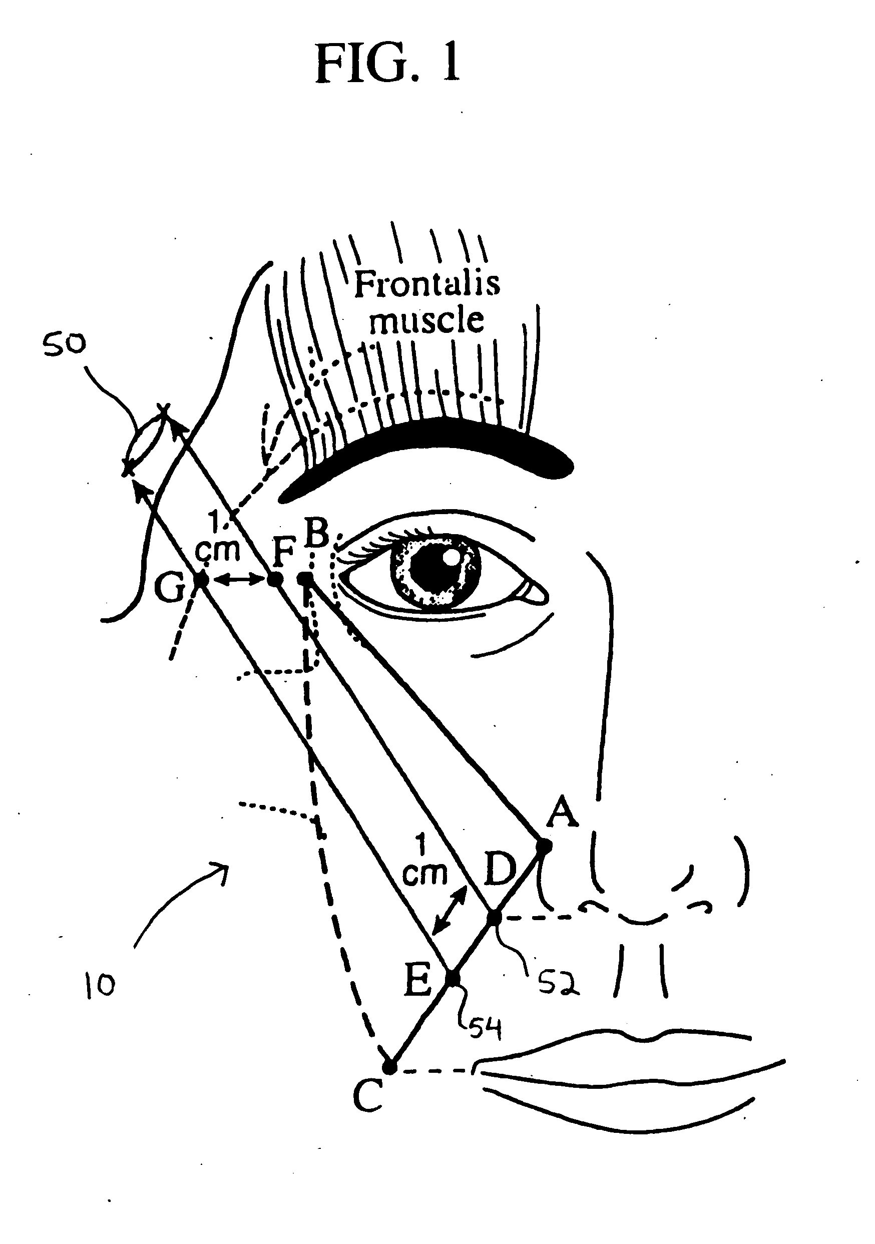 Suture and method using a suture