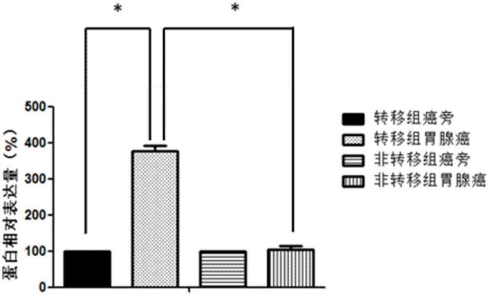 Application of MCM8 as gastric adenocarcinoma metastasis marker