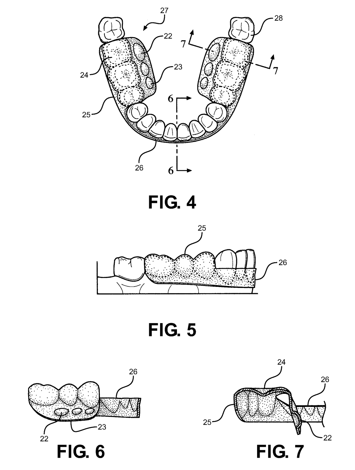 Method and Oral Appliance for Improving Air Intake and Reducing Bruxism