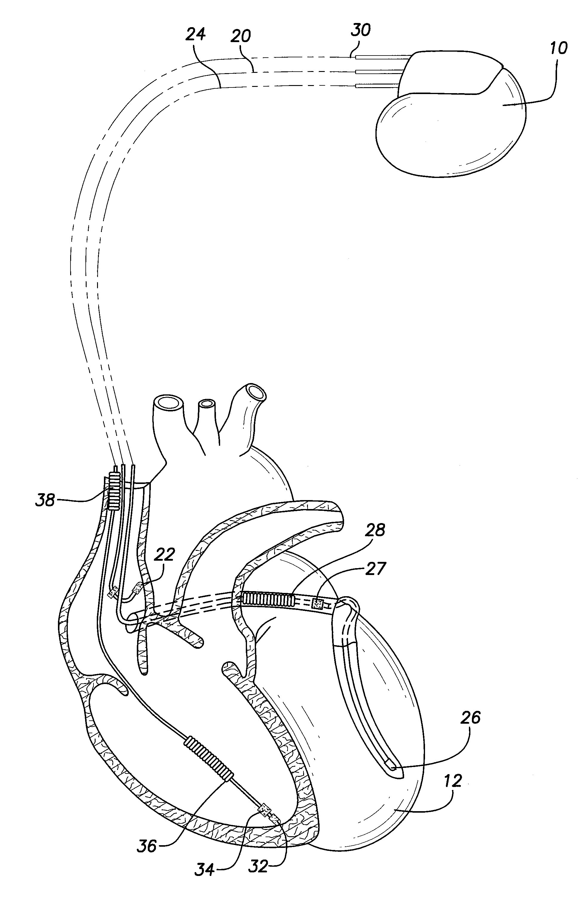 Method and system for detecting and treating junctional rhythms