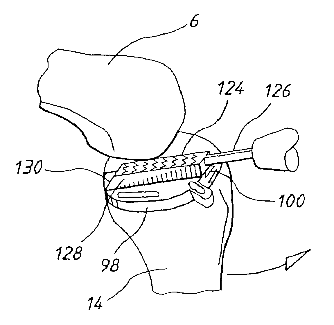 Apparatus for use in arthroplasty of the knees