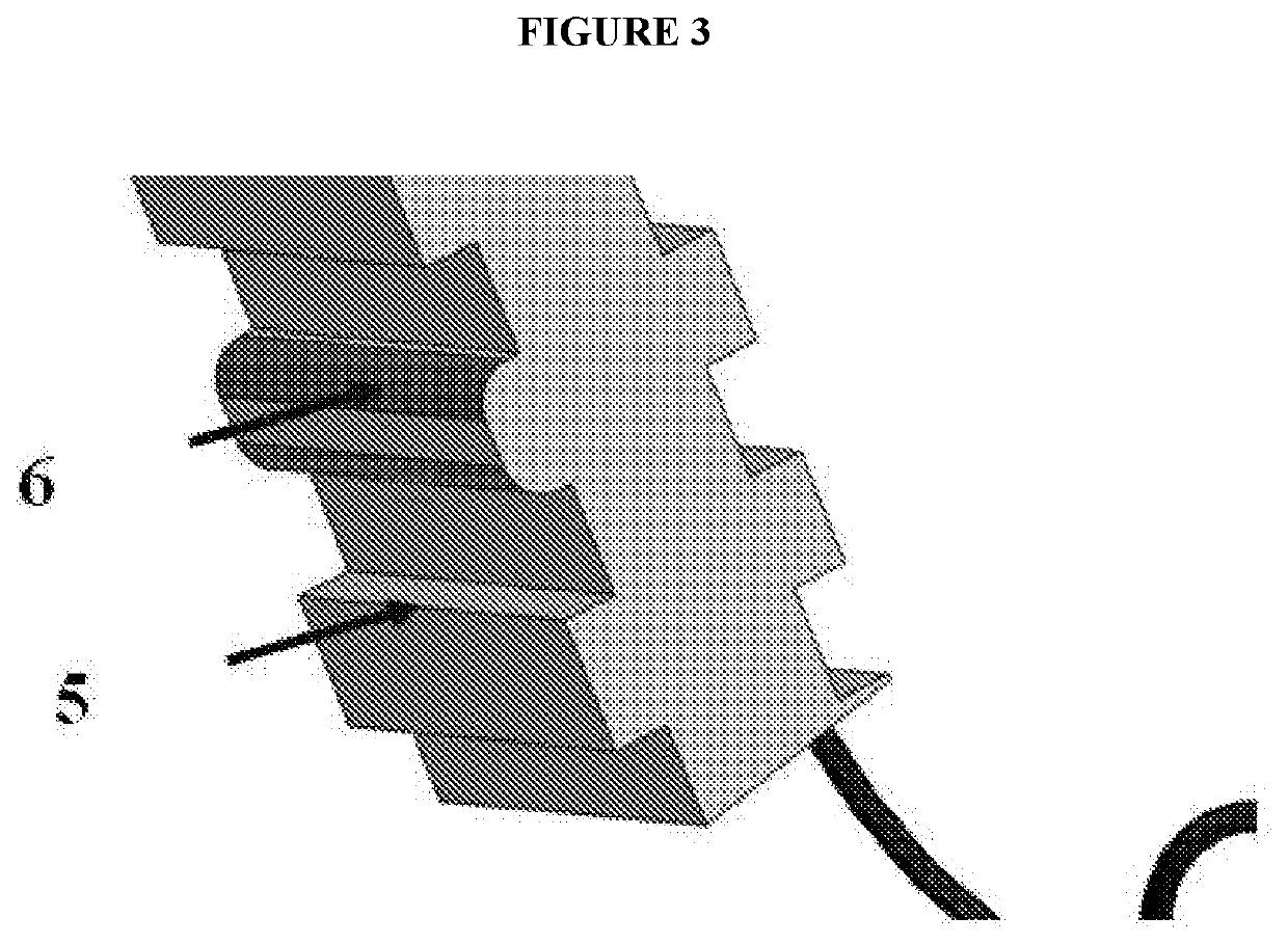 Devices and methods for stabilization of an ocular lens capsule and preventing artificial intraocular lens implant rotation post cataract surgery