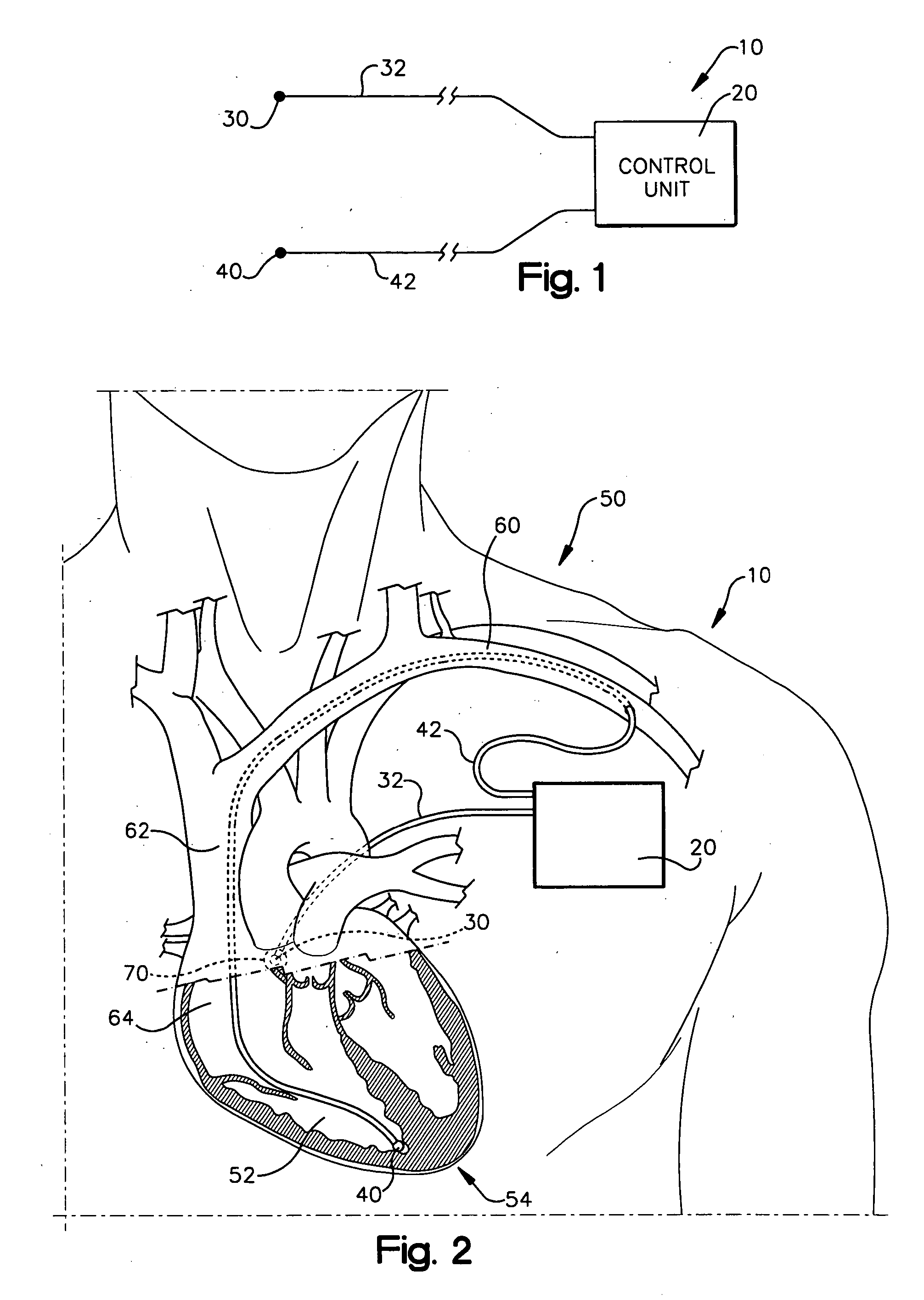 System and method for achieving regular slow ventricular rhythm in response to atrial fibrillation