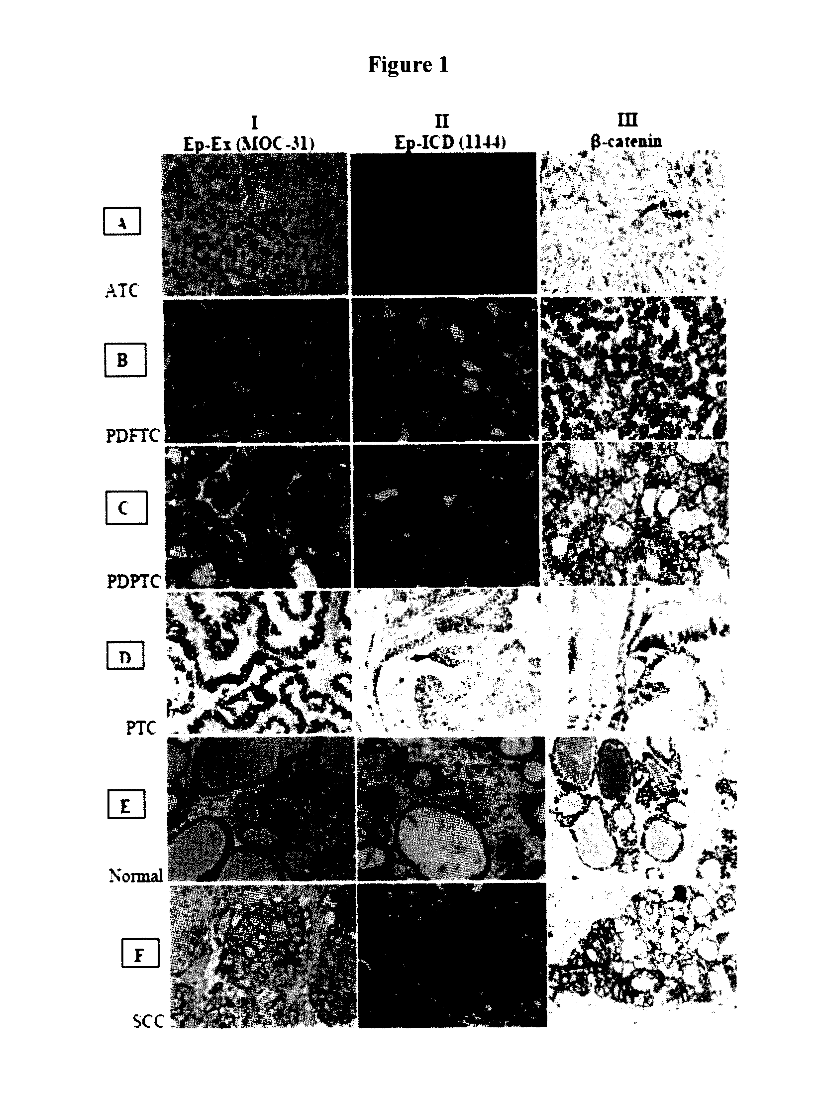Methods and compositions for the diagnosis and treatment of thyroid cancer