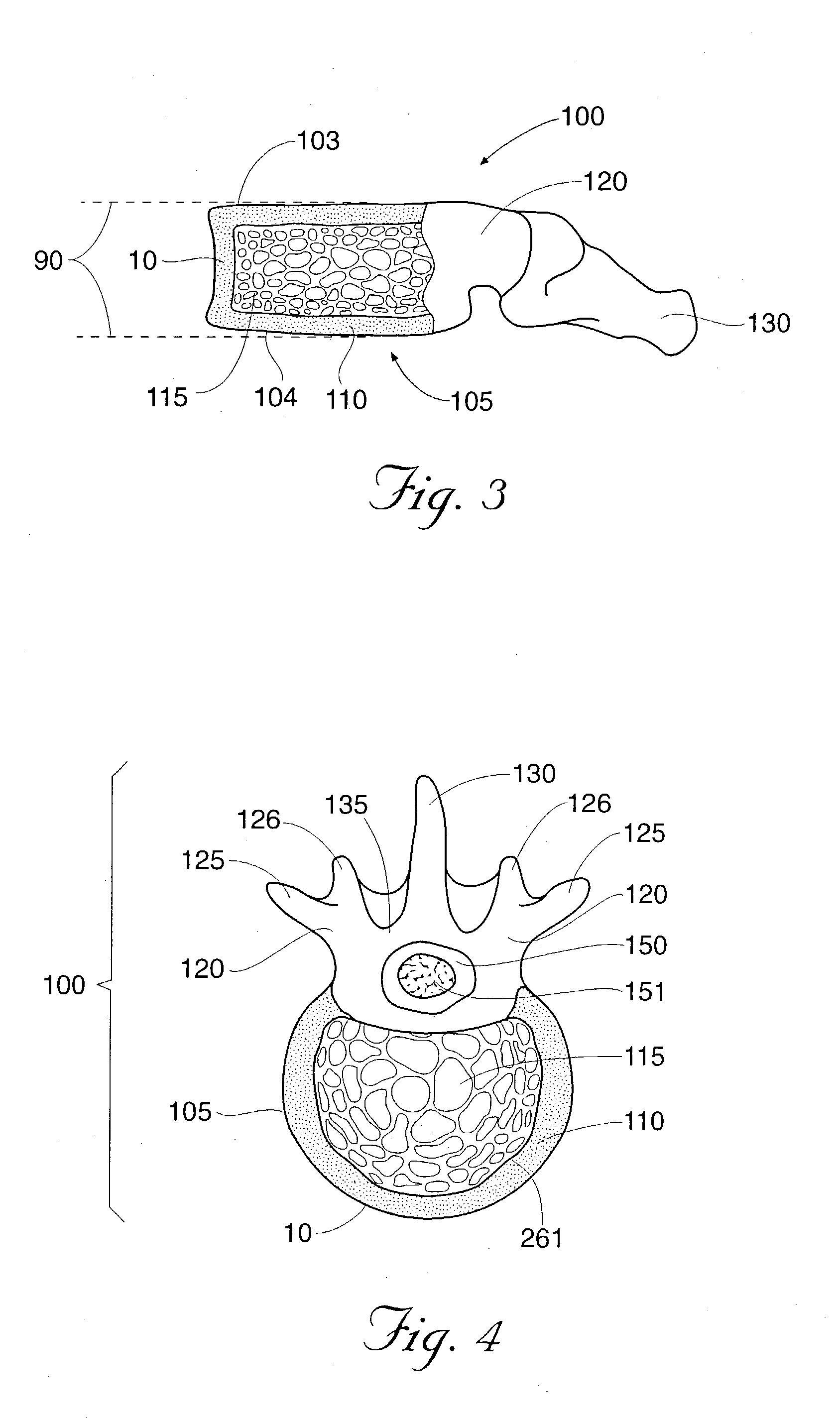 Methods and devices for treating fractured and/or diseased bone