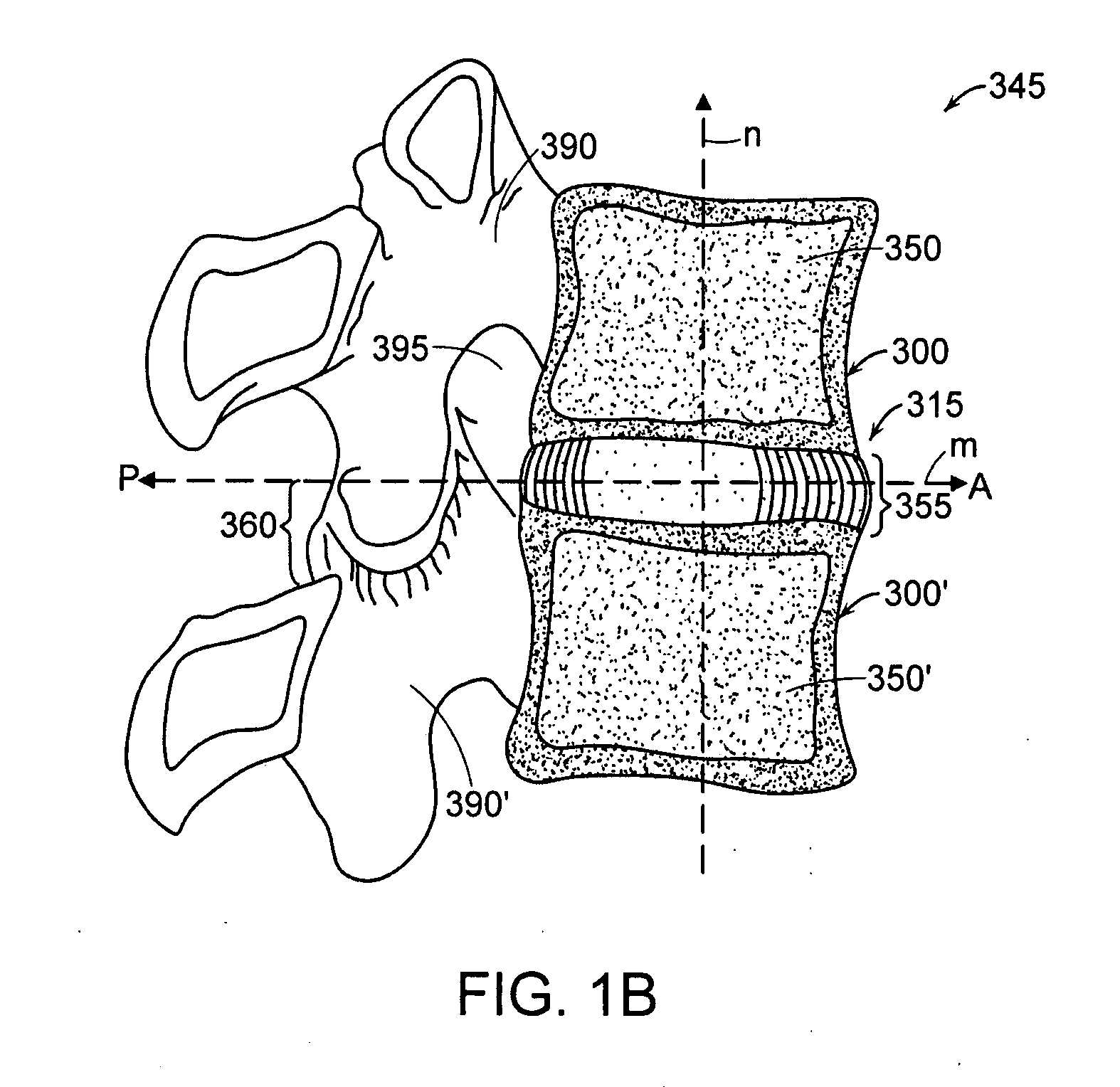 Devices and methods for stabilizing a spinal region