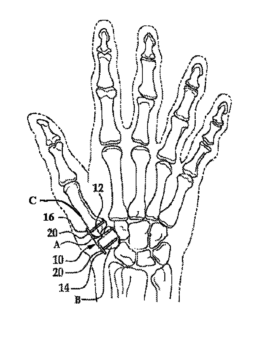 Surgical technique using a contoured allograft cartilage as a spacer of the carpo-metacarpal joint of the thumb or tarso-metatarsal joint of the toe