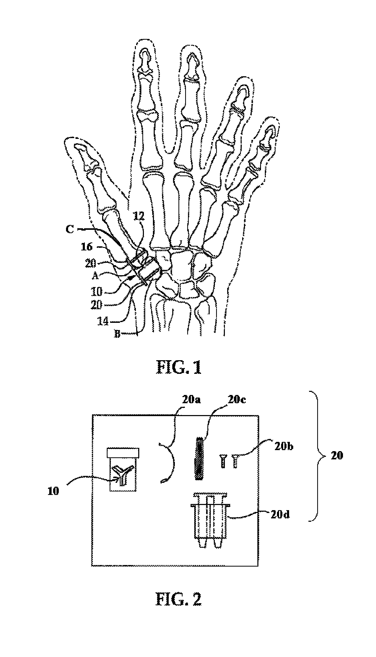 Surgical technique using a contoured allograft cartilage as a spacer of the carpo-metacarpal joint of the thumb or tarso-metatarsal joint of the toe