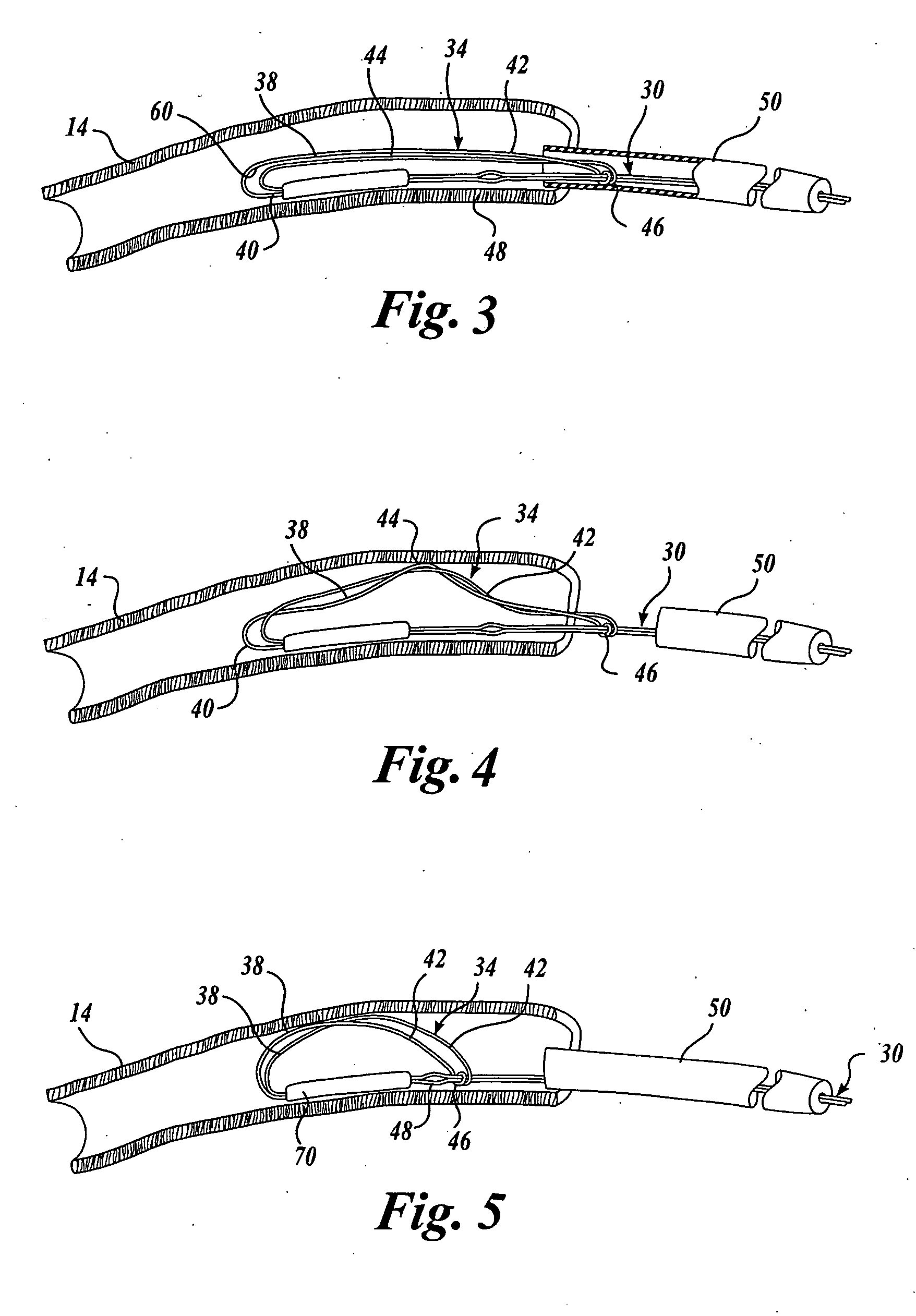 Body lumen device anchor, device and assembly