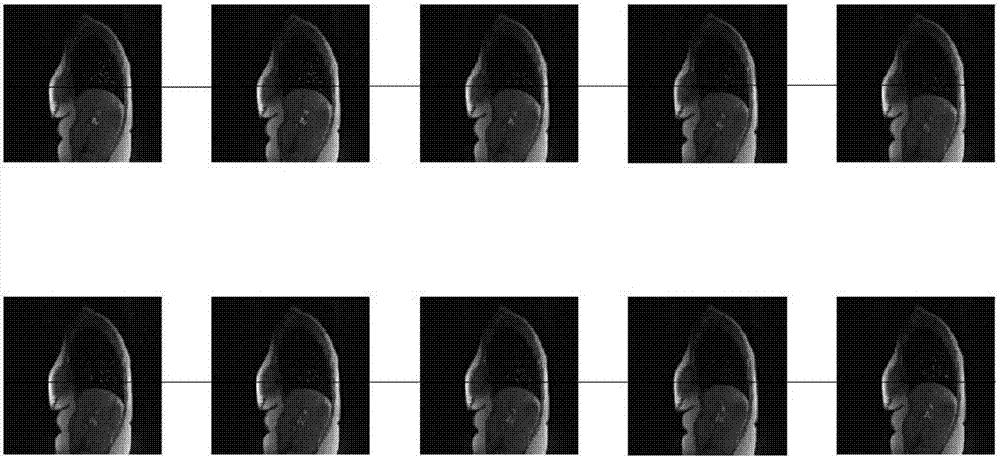 A 4d-mri super-resolution reconstruction method based on dual-dictionary learning