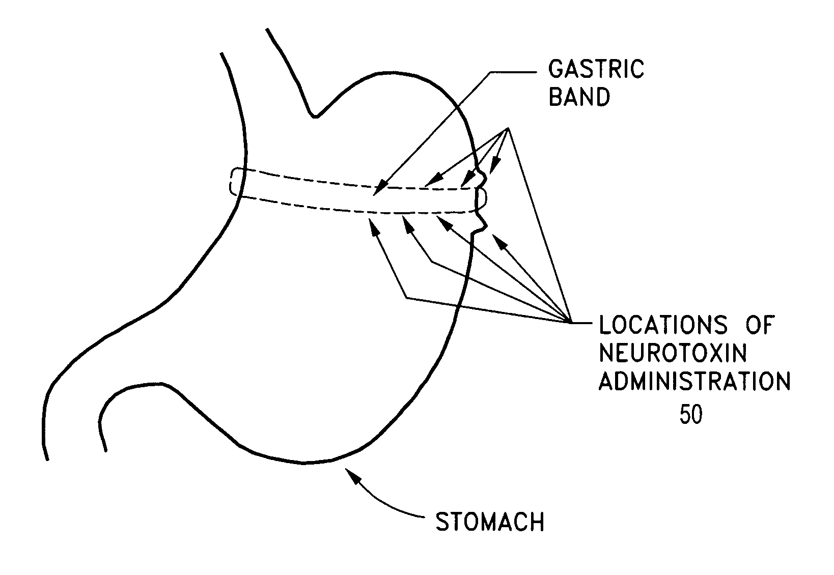 Apparatus and method for treating obesity using neurotoxins in conjunction with bariatric procedures