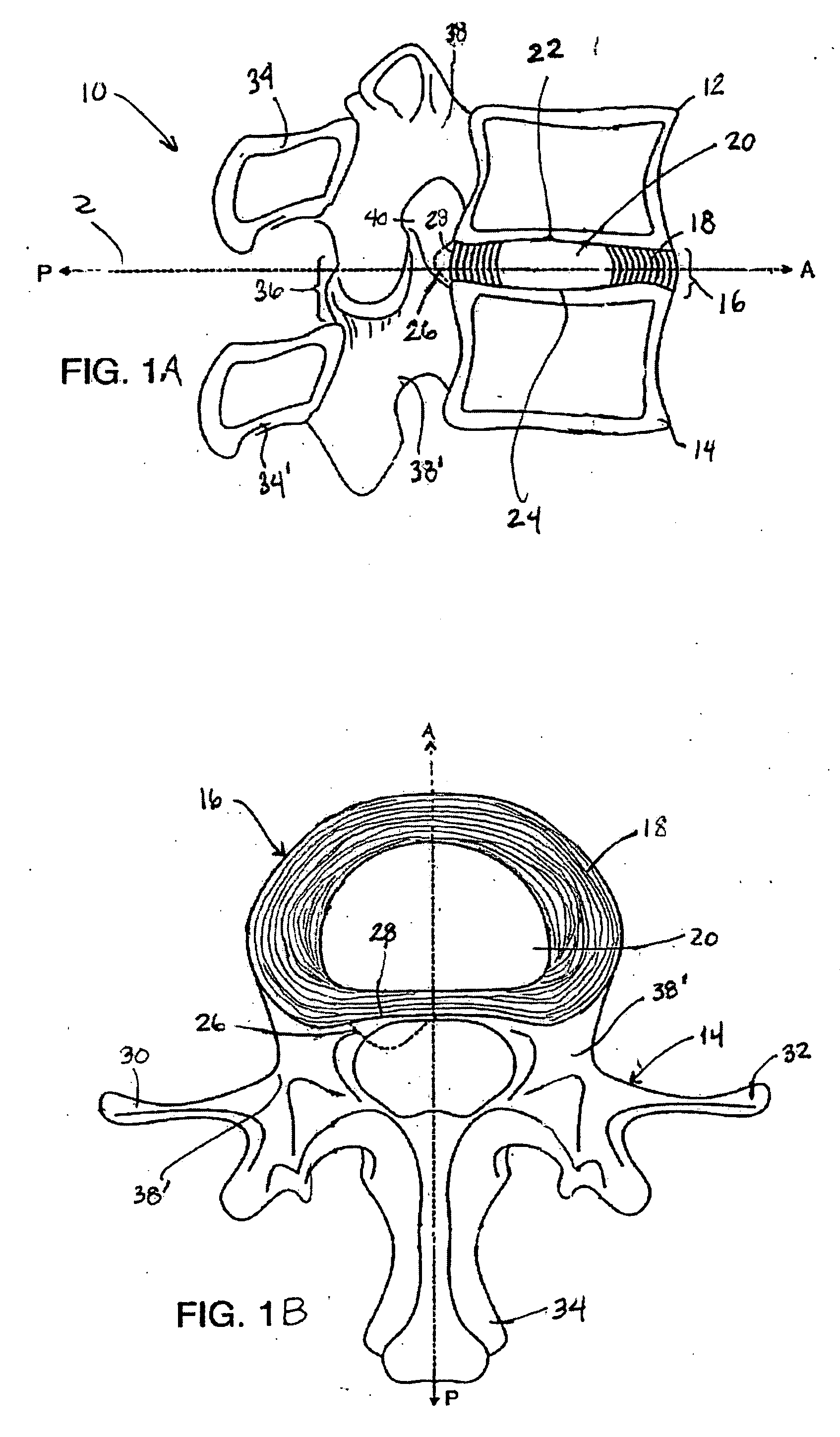 Spinal disc annulus augmentation