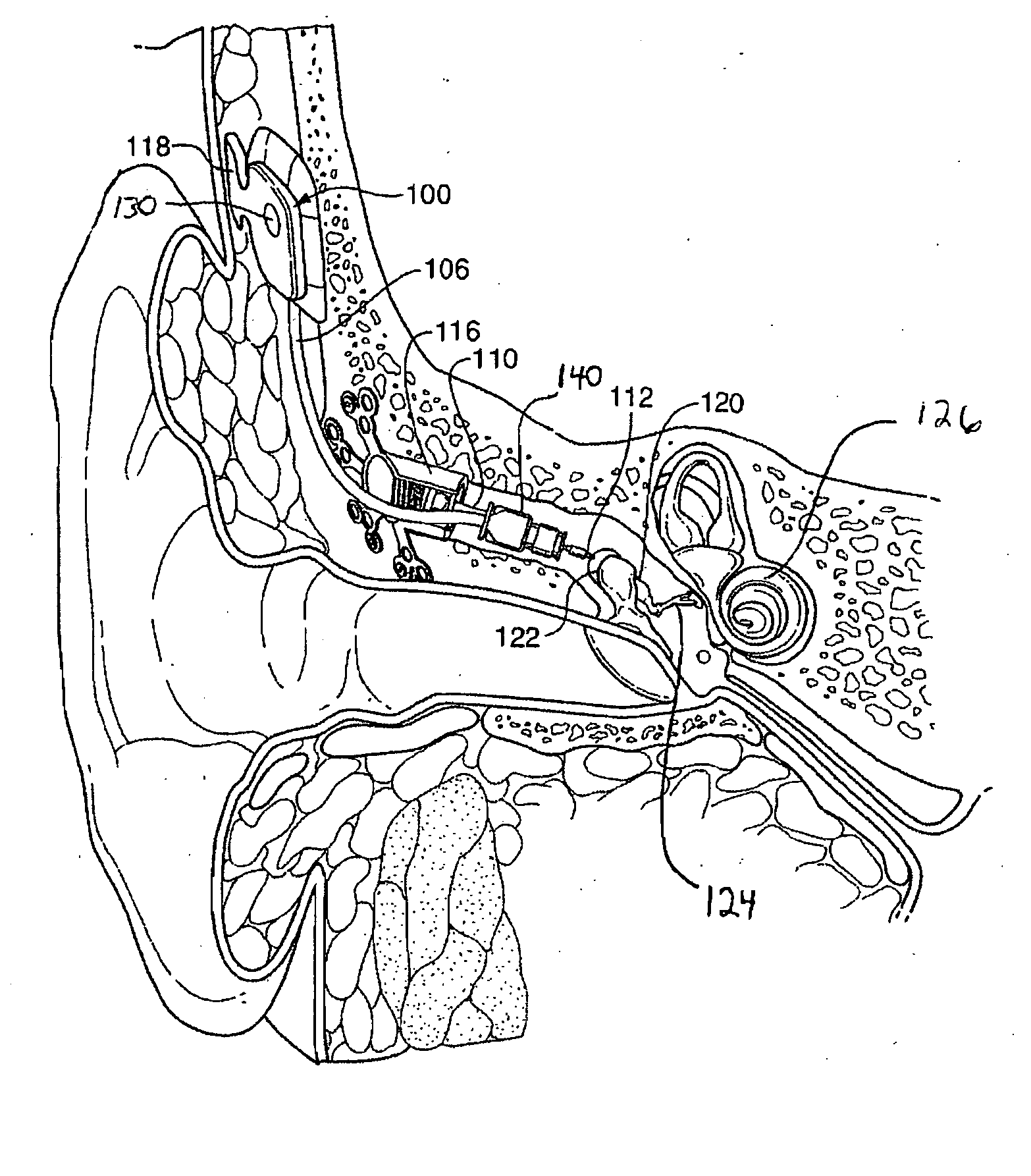 Implantable transducer with transverse force application