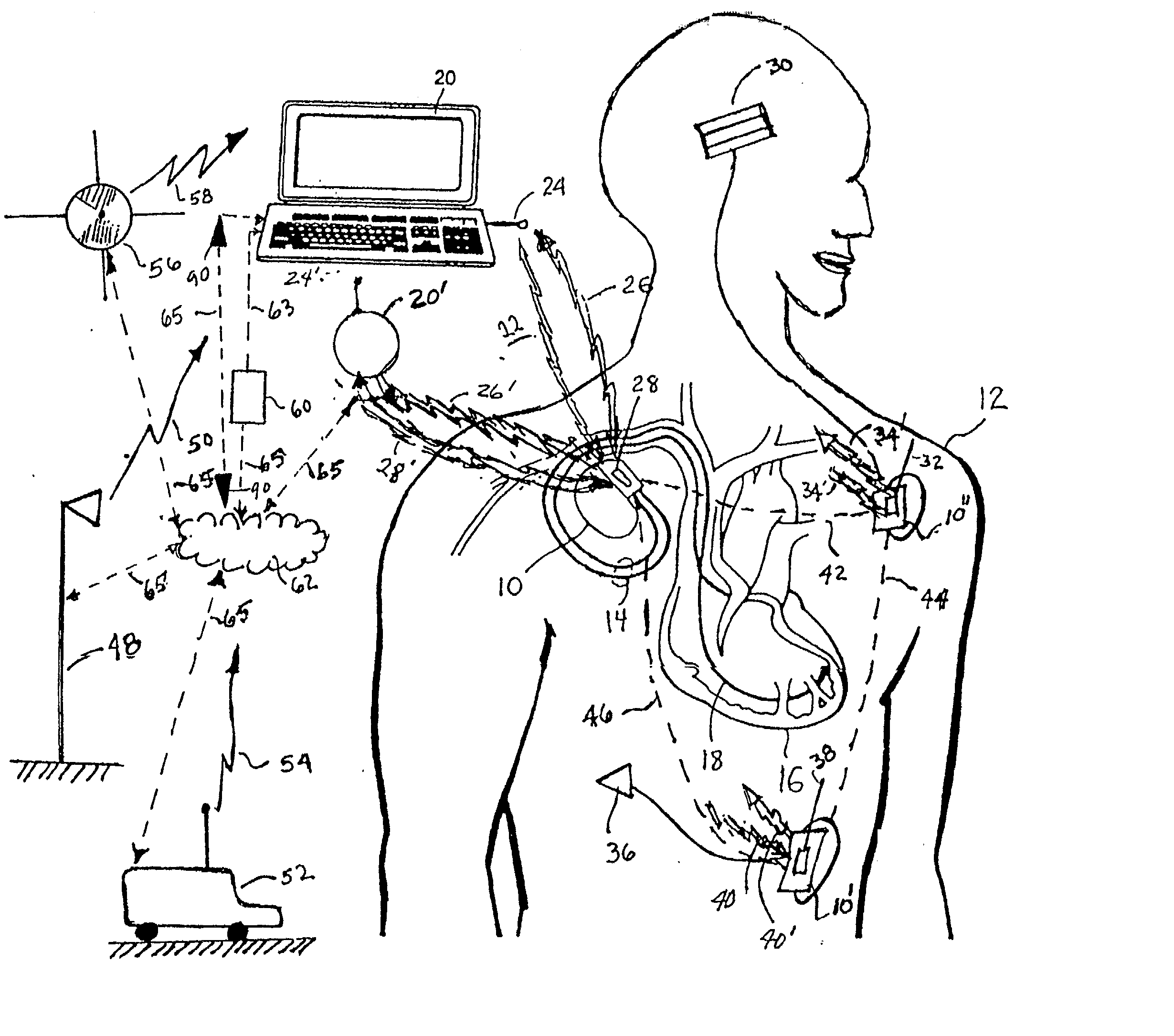 Method and apparatus for remotely programming implantable medical devices