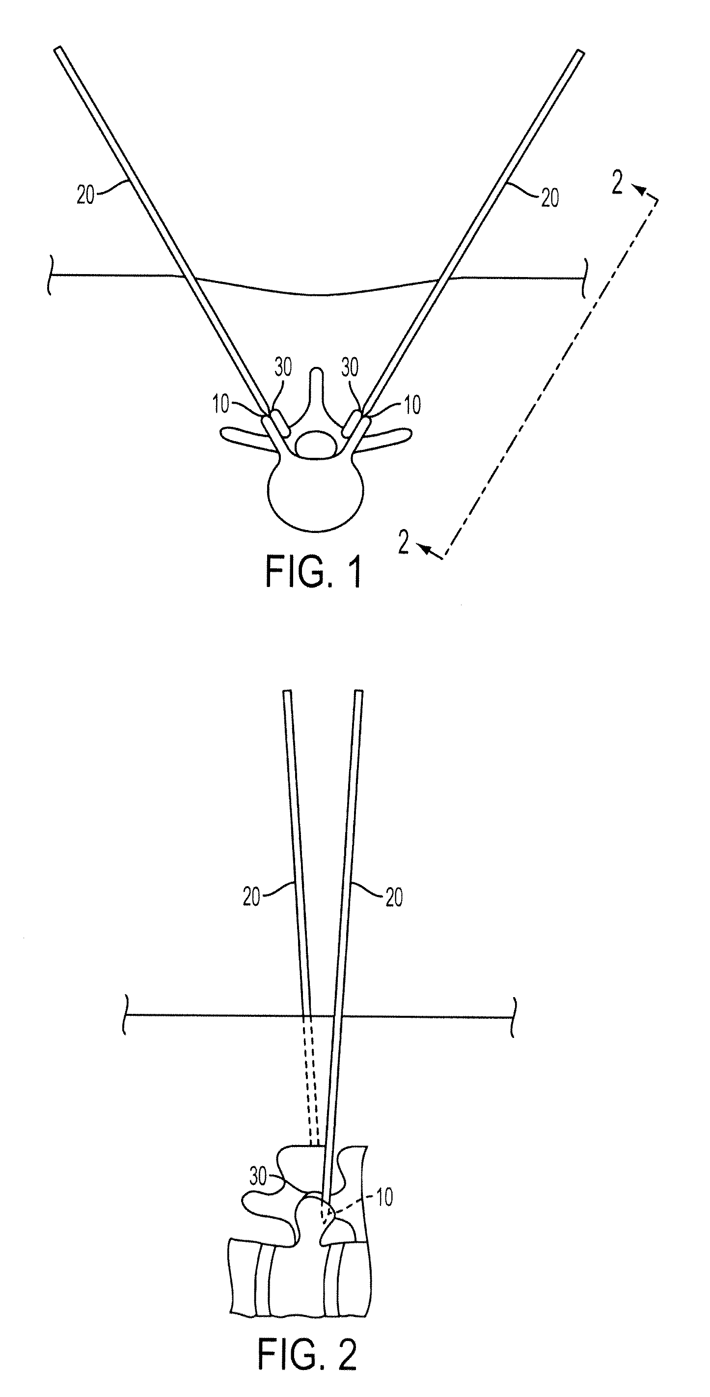 Methods and Surgical Kits for Minimally-Invasive Facet Joint Fusion