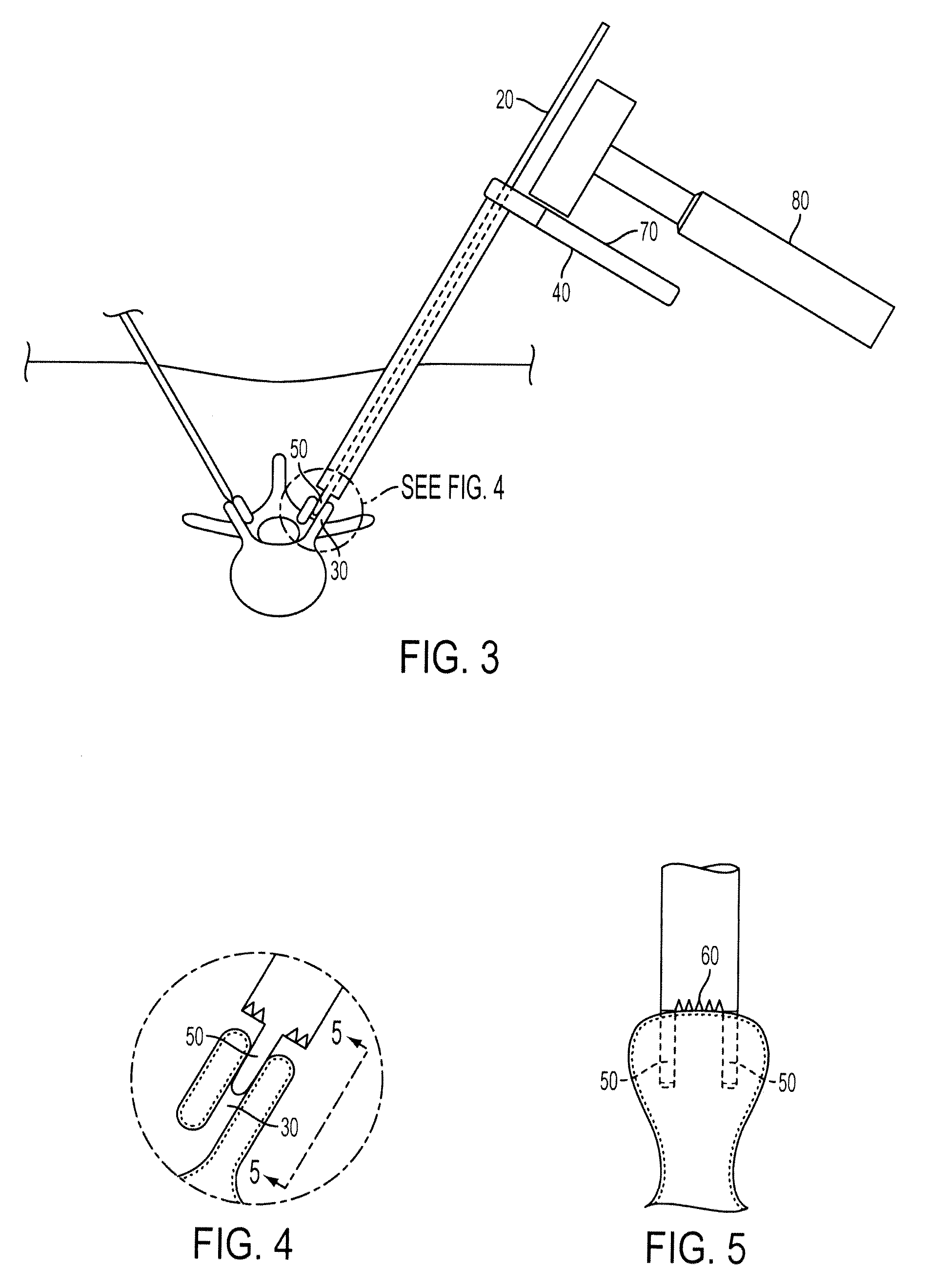 Methods and Surgical Kits for Minimally-Invasive Facet Joint Fusion