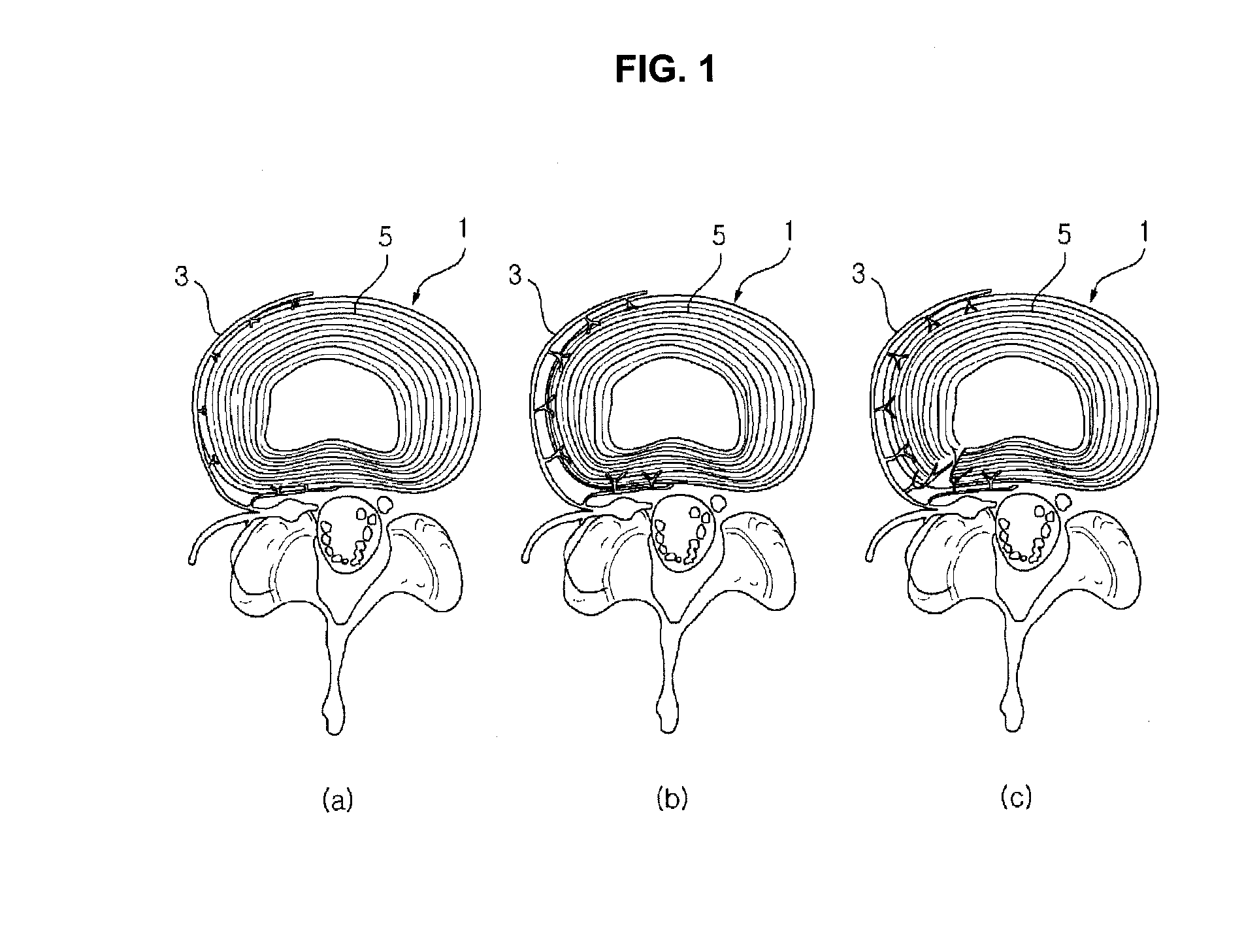 Probe and device for detecting abnormality of intervertebral disc