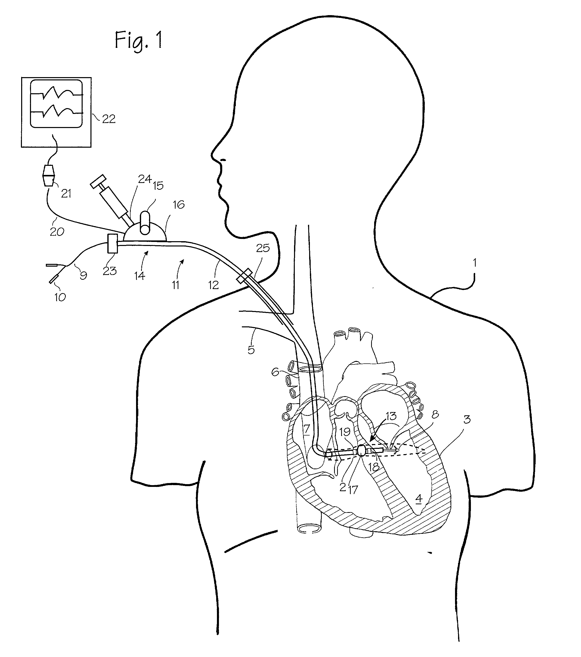 Catheter systems and methods for placing bi-ventricular pacing leads