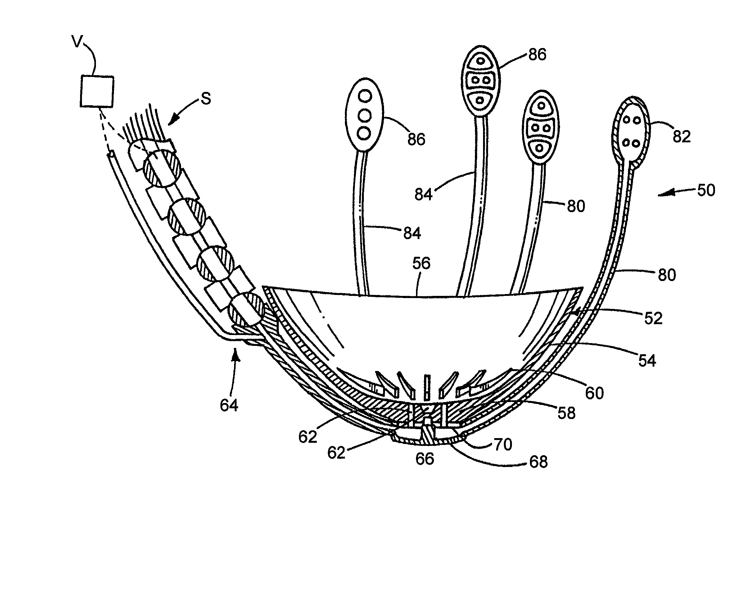 Device to permit offpump beating heart coronary bypass surgery