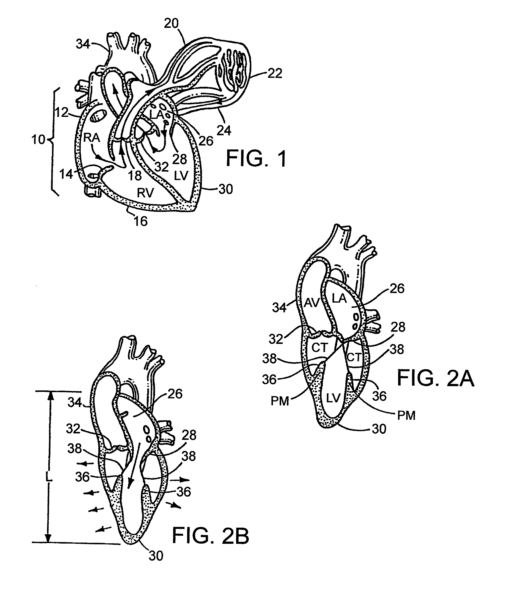 Device to permit offpump beating heart coronary bypass surgery